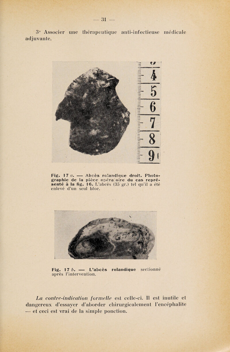 3° Associer une thérapeutique anti-infectieuse médicale adjuvante. Fig. 17 g. — Abcès rolandique droit. Photo¬ graphie de la pièce opératoire du cas repré¬ senté à la fi g. 16. L’abcès (35 gr.) tel qu’il a été enlevé d’un seul bloc. Fig. 17 b. — L’abcès rolandique après l’intervention. sectionné La contre-indication formelle est celle-ci. Il est inutile et dangereux d’essayer d’aborder chirurgicalement l’encéphalite — et ceci est vrai de la simple ponction.