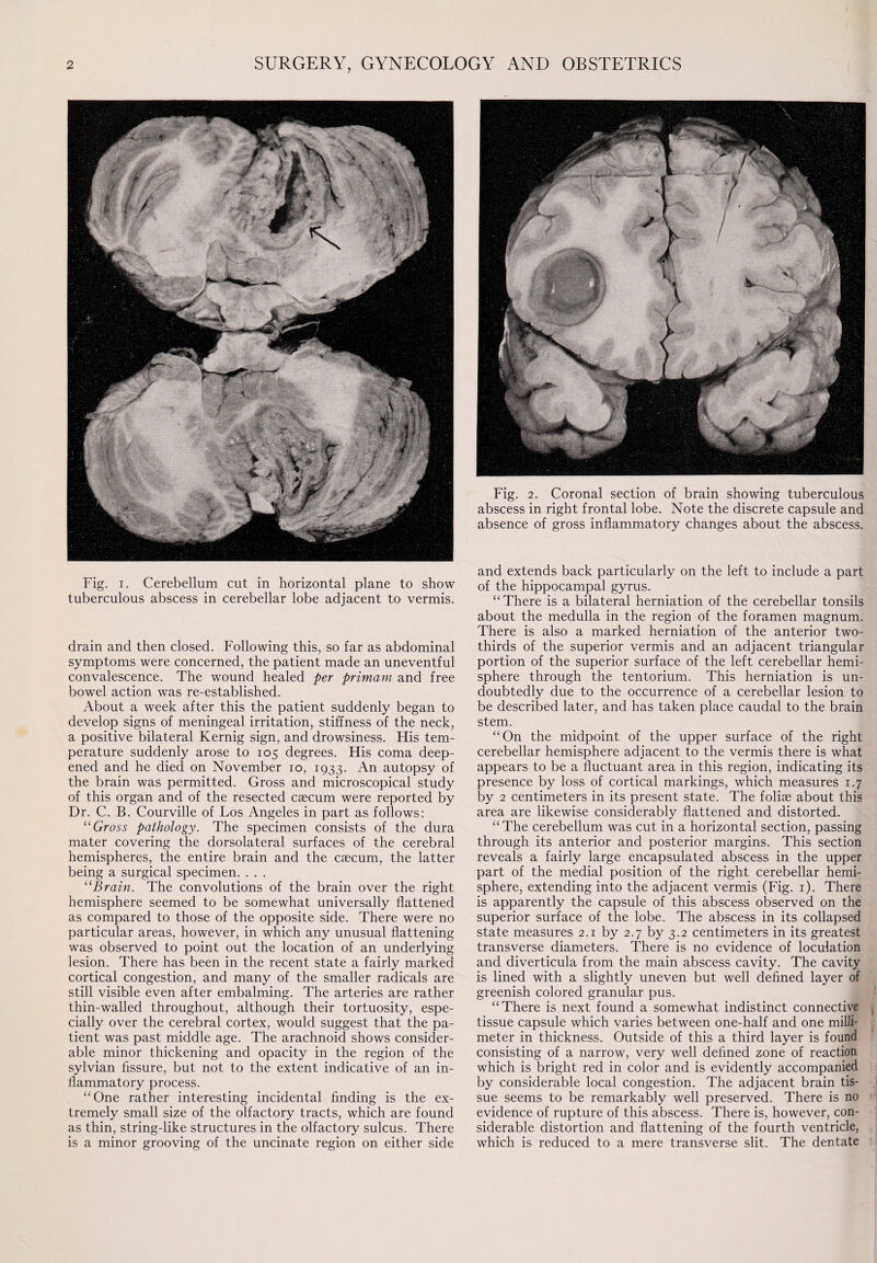 Fig. i. Cerebellum cut in horizontal plane to show tuberculous abscess in cerebellar lobe adjacent to vermis. drain and then closed. Following this, so far as abdominal symptoms were concerned, the patient made an uneventful convalescence. The wound healed per primam and free bowel action was re-established. About a week after this the patient suddenly began to develop signs of meningeal irritation, stiffness of the neck, a positive bilateral Kernig sign, and drowsiness. His tem¬ perature suddenly arose to 105 degrees. His coma deep¬ ened and he died on November 10, 1933. An autopsy of the brain was permitted. Gross and microscopical study of this organ and of the resected caecum were reported by Dr. C. B. Courville of Los Angeles in part as follows: “Gross pathology. The specimen consists of the dura mater covering the dorsolateral surfaces of the cerebral hemispheres, the entire brain and the caecum, the latter being a surgical specimen. . . . “Brain. The convolutions of the brain over the right hemisphere seemed to be somewhat universally flattened as compared to those of the opposite side. There were no particular areas, however, in which any unusual flattening was observed to point out the location of an underlying lesion. There has been in the recent state a fairly marked cortical congestion, and many of the smaller radicals are still visible even after embalming. The arteries are rather thin-walled throughout, although their tortuosity, espe¬ cially over the cerebral cortex, would suggest that the pa¬ tient was past middle age. The arachnoid shows consider¬ able minor thickening and opacity in the region of the sylvian fissure, but not to the extent indicative of an in¬ flammatory process. “One rather interesting incidental finding is the ex¬ tremely small size of the olfactory tracts, which are found as thin, string-like structures in the olfactory sulcus. There is a minor grooving of the uncinate region on either side Fig. 2. Coronal section of brain showing tuberculous abscess in right frontal lobe. Note the discrete capsule and absence of gross inflammatory changes about the abscess. and extends back particularly on the left to include a part of the hippocampal gyrus. “There is a bilateral herniation of the cerebellar tonsils about the medulla in the region of the foramen magnum. There is also a marked herniation of the anterior two- thirds of the superior vermis and an adjacent triangular portion of the superior surface of the left cerebellar hemi¬ sphere through the tentorium. This herniation is un¬ doubtedly due to the occurrence of a cerebellar lesion to be described later, and has taken place caudal to the brain stem. “On the midpoint of the upper surface of the right cerebellar hemisphere adjacent to the vermis there is what appears to be a fluctuant area in this region, indicating its presence by loss of cortical markings, which measures 1.7 by 2 centimeters in its present state. The foliae about this area are likewise considerably flattened and distorted. “The cerebellum was cut in a horizontal section, passing through its anterior and posterior margins. This section reveals a fairly large encapsulated abscess in the upper part of the medial position of the right cerebellar hemi¬ sphere, extending into the adjacent vermis (Fig. 1). There is apparently the capsule of this abscess observed on the superior surface of the lobe. The abscess in its collapsed state measures 2.1 by 2.7 by 3.2 centimeters in its greatest transverse diameters. There is no evidence of loculation and diverticula from the main abscess cavity. The cavity is lined with a slightly uneven but well defined layer of greenish colored granular pus. “There is next found a somewhat indistinct connective tissue capsule which varies between one-half and one milli¬ meter in thickness. Outside of this a third layer is found consisting of a narrow, very well defined zone of reaction which is bright red in color and is evidently accompanied by considerable local congestion. The adjacent brain tis¬ sue seems to be remarkably well preserved. There is no evidence of rupture of this abscess. There is, however, con¬ siderable distortion and flattening of the fourth ventricle, which is reduced to a mere transverse slit. The dentate