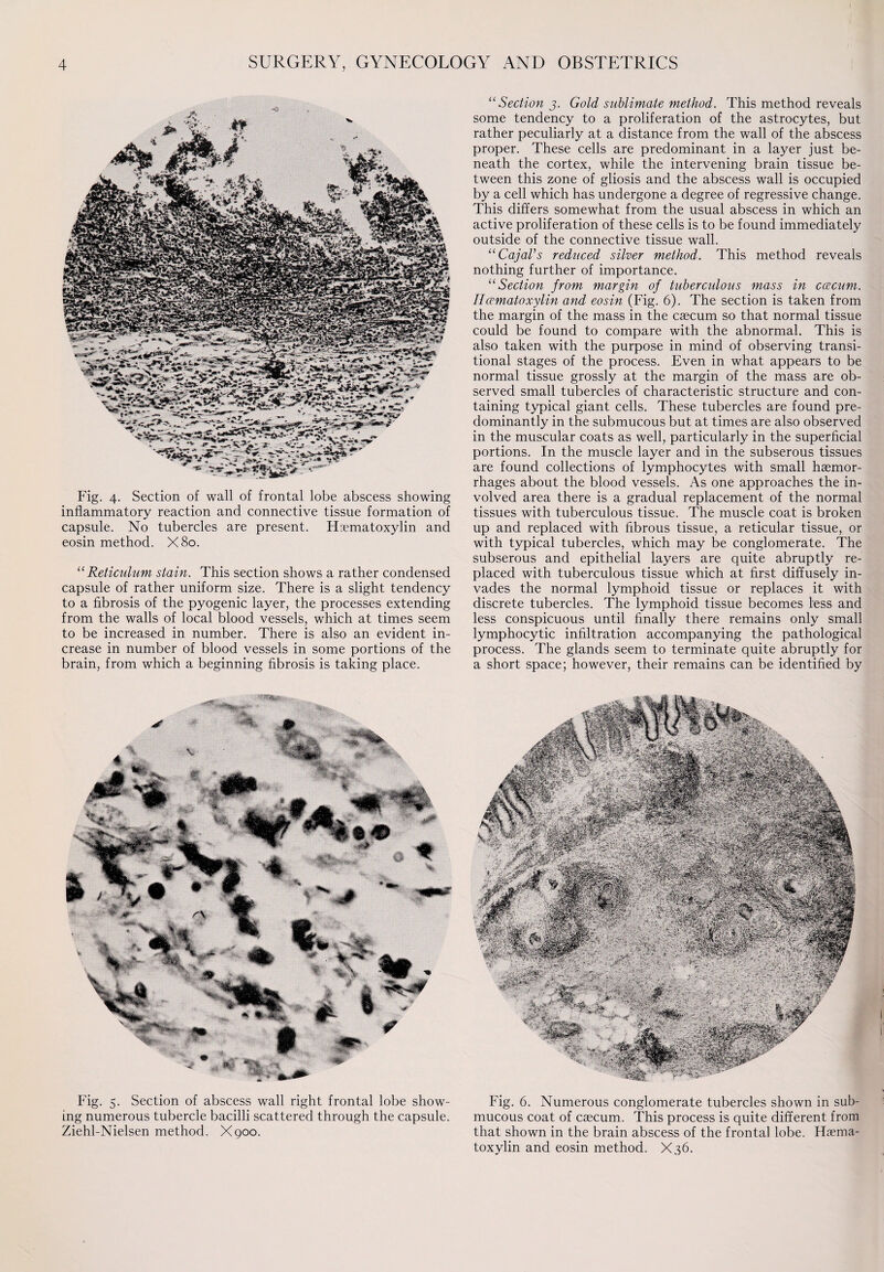 Fig. 4. Section of wall of frontal lobe abscess showing inflammatory reaction and connective tissue formation of capsule. No tubercles are present. Haematoxylin and eosin method. X80. “Reticulum stain. This section shows a rather condensed capsule of rather uniform size. There is a slight tendency to a fibrosis of the pyogenic layer, the processes extending from the walls of local blood vessels, which at times seem to be increased in number. There is also an evident in¬ crease in number of blood vessels in some portions of the brain, from which a beginning fibrosis is taking place. Fig. 5. Section of abscess wall right frontal lobe show¬ ing numerous tubercle bacilli scattered through the capsule. Ziehl-Nielsen method. X900. “ Section 3. Gold sublimate method. This method reveals some tendency to a proliferation of the astrocytes, but rather peculiarly at a distance from the wall of the abscess proper. These cells are predominant in a layer just be¬ neath the cortex, while the intervening brain tissue be¬ tween this zone of gliosis and the abscess wall is occupied by a cell which has undergone a degree of regressive change. This differs somewhat from the usual abscess in which an active proliferation of these cells is to be found immediately outside of the connective tissue wall. “CajaVs reduced silver method. This method reveals nothing further of importance. “ Section from margin of tuberculous mass in ccecum. IIcematoxylin and eosin (Fig. 6). The section is taken from the margin of the mass in the caecum so that normal tissue could be found to compare with the abnormal. This is also taken with the purpose in mind of observing transi¬ tional stages of the process. Even in what appears to be normal tissue grossly at the margin of the mass are ob¬ served small tubercles of characteristic structure and con¬ taining typical giant cells. These tubercles are found pre¬ dominantly in the submucous but at times are also observed in the muscular coats as well, particularly in the superficial portions. In the muscle layer and in the subserous tissues are found collections of lymphocytes with small haemor¬ rhages about the blood vessels. As one approaches the in¬ volved area there is a gradual replacement of the normal tissues with tuberculous tissue. The muscle coat is broken up and replaced with fibrous tissue, a reticular tissue, or with typical tubercles, which may be conglomerate. The subserous and epithelial layers are quite abruptly re¬ placed with tuberculous tissue which at first diffusely in¬ vades the normal lymphoid tissue or replaces it with discrete tubercles. The lymphoid tissue becomes less and less conspicuous until finally there remains only small lymphocytic infiltration accompanying the pathological process. The glands seem to terminate quite abruptly for a short space; however, their remains can be identified by Fig. 6. Numerous conglomerate tubercles shown in sub¬ mucous coat of caecum. This process is quite different from that shown in the brain abscess of the frontal lobe. Haema- toxylin and eosin method. X36.