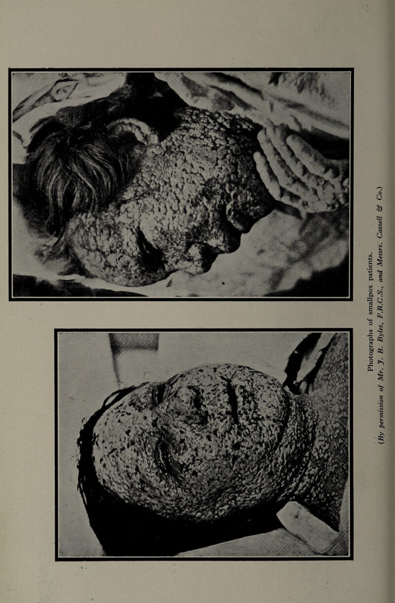 Photographs of smallpox patients. (By permission of Mr. J. B. Byles, F.R.C.S., and Messrs. Cassell & Co.)