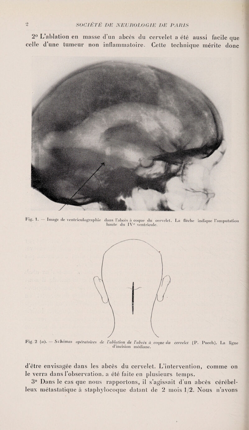 2° L’ablation en masse d’un abcès du cervelet a été aussi facile que celle d’une tumeur non inflammatoire. Cette technique mérite donc Hg. 1. — Image de ventriculographie dans l’abcès à coque du cervelet. haute du IVe ventricule. La flèche indique l’amputation Fig. 2 (a). — Schémas opératoires de l’ablation de d’incision l’abcès à coque du cervelet (P. Puech). La ligne médiane. d’être envisagée dans les abcès du cervelet. L’intervention, comme on le verra dans l’observation, a été faite en plusieurs temps. 3° Dans le cas que nous rapportons, il s’agissait d’un abcès cérébel¬