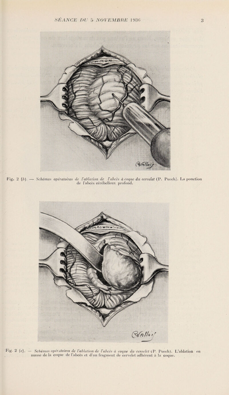 Fig. 2 [b). — Schémas opératoires de l'ablation de l’abcès à coque du cervelet (P. Puech). La ponction de l’abcès cérébelleux profond. I'ig. 2 (c). — Schémas opératoires de l’ablation de l’abcès à coque du cervelet (P. Puech). L’ablation en masse de la coque de l’abcès et d’un fragment de cervelet adhérent à la coque.