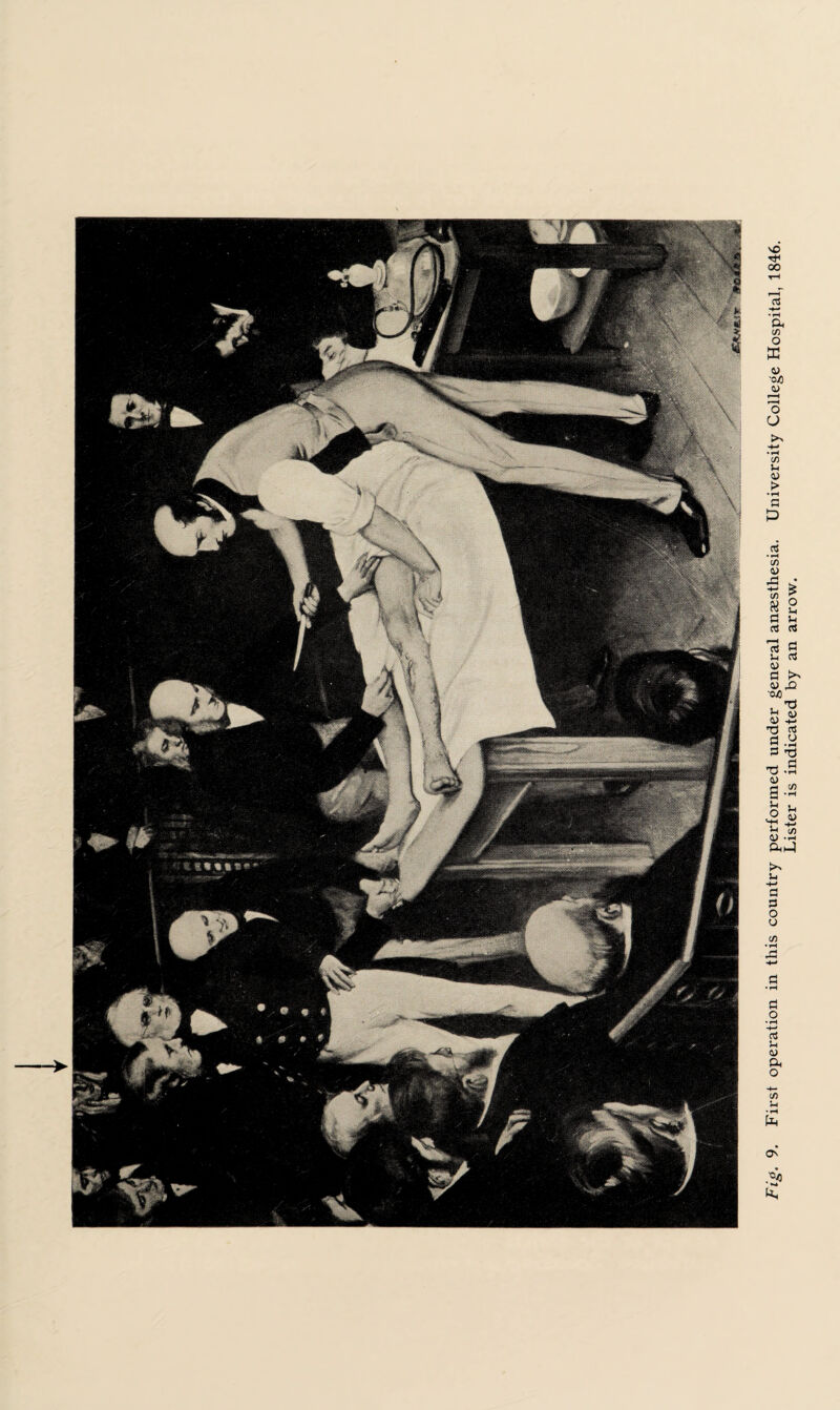 First operation in this country performed under general anaesthesia. University College Hospital, 1846. Lister is indicated by an arrow.