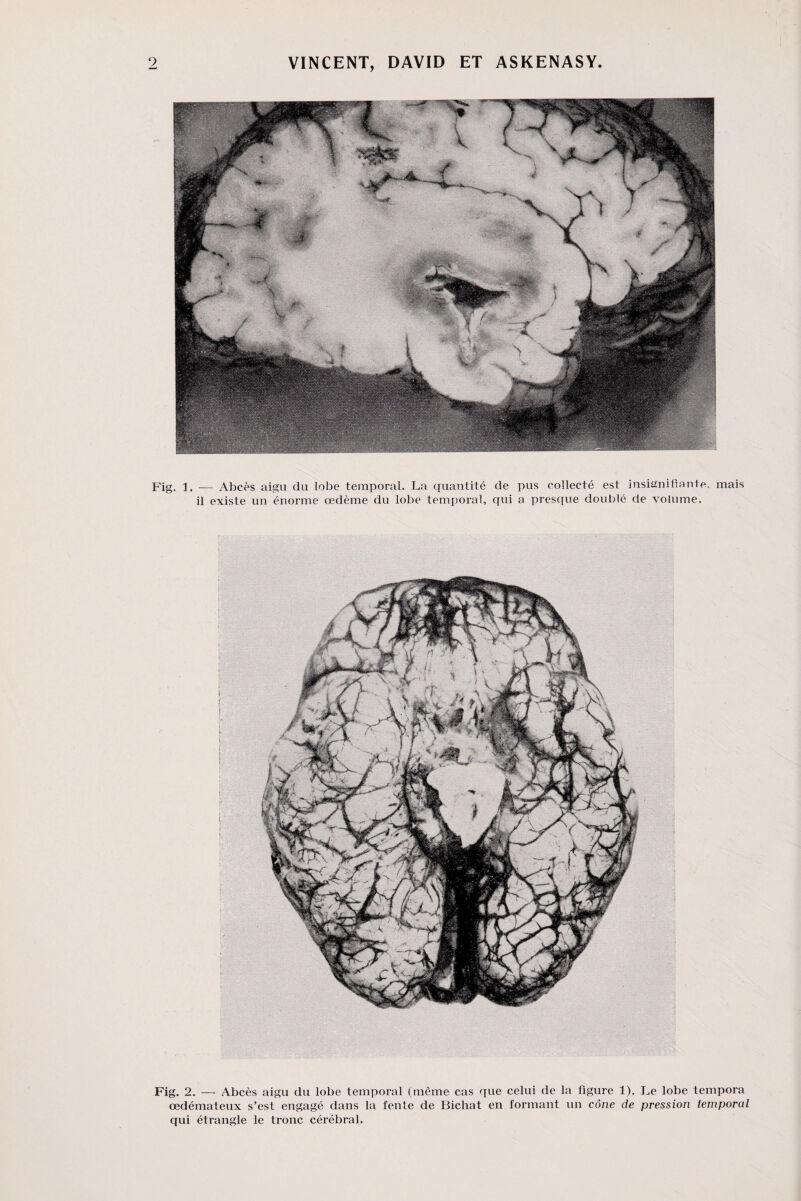 Fig. 1. — Abcès aigu du lobe temporal. La quantité de pus collecté est insignifiante, mais il existe un énorme œdème du lobe temporal, qui a presque doublé de volume. Fig. 2. — Abcès aigu du lobe temporal (même cas que celui de la figure 1). Le lobe tempora œdémateux s’est engagé dans la fente de Bichat en formant un cône de pression temporal qui étrangle le tronc cérébral.