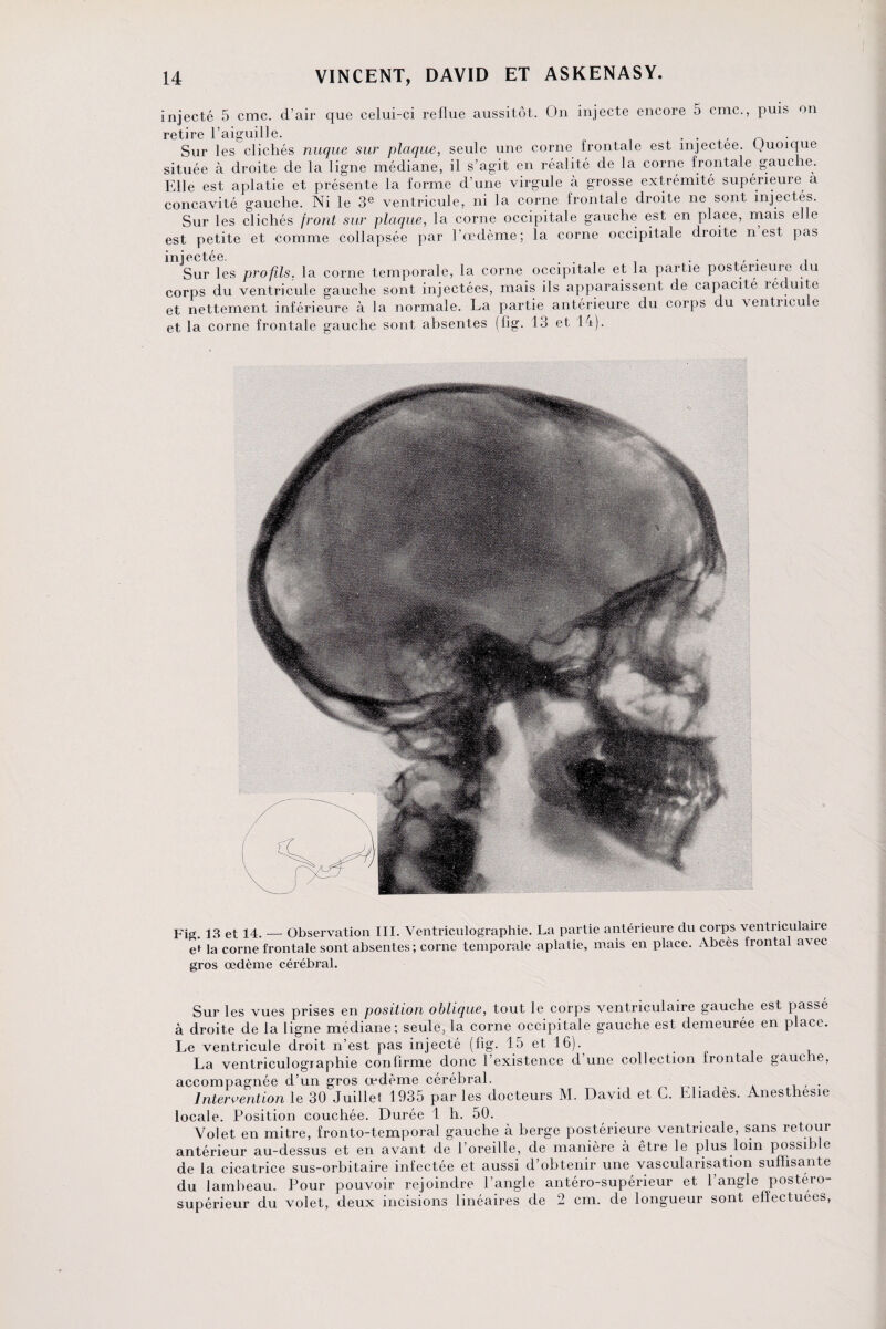 injecté 5 cmc. d’air que celui-ci reflue aussitôt. On injecte encore 5 cmc., puis on retire l’aiguille. . . , Sur les clichés nuque sur plaque, seule une corne frontale est mjectee. (Quoique située à droite de la ligne médiane, il s’agit en réalité de la corne frontale gauche. Fdle est aplatie et présente la forme d’une virgule à grosse extrémité supérieure a concavité gauche. Ni le 3e ventricule, ni la corne frontale droite ne sont injectés. Sur les clichés front sur plaque, la corne occipitale gauche est en place, mais elle est petite et comme collapsée par l’œdème; la corne occipitale droite n est pas injectée. . , . -, Sur les profils, la corne temporale, la corne occipitale et la partie postérieure du corps du ventricule gauche sont injectées, mais ils apparaissent de capacité réduite et nettement inférieure à la normale. La partie antérieure du corps du ventricule et la corne frontale gauche sont absentes (fig. 13 et 14). Fig. 13 et 14. — Observation III. Ventriculographie. La partie antérieure du corps ventriculaire ei la corne frontale sont absentes ; corne temporale aplatie, mais en place. Abcès frontal avec gros œdème cérébral. Sur les vues prises en position oblique, tout le corps ventriculaire gauche est passe à droite de la ligne médiane; seule, la corne occipitale gauche est demeurée en place. Le ventricule droit n’est pas injecté (fig. 15 et 16). La ventriculographie confirme donc l’existence d’une collection frontale gauche, accompagnée d’un gros œdème cérébral. . Intervention le 30 Juillet 1935 par les docteurs M. David et C. Eliadès. Anesthesie locale. Position couchée. Durée 1 h. 50. Volet en mitre, fronto-temporal gauche à berge postérieure ventricale, sans retour antérieur au-dessus et en avant de l’oreille, de manière à être le plus loin possible de la cicatrice sus-orbitaire infectée et aussi d’obtenir une vascularisation suffisante du lambeau. Pour pouvoir rejoindre l’angle antéro-supérieur et l’angle postéro¬ supérieur du volet, deux incisions linéaires de 2 cm. de longueur sont effectuées,
