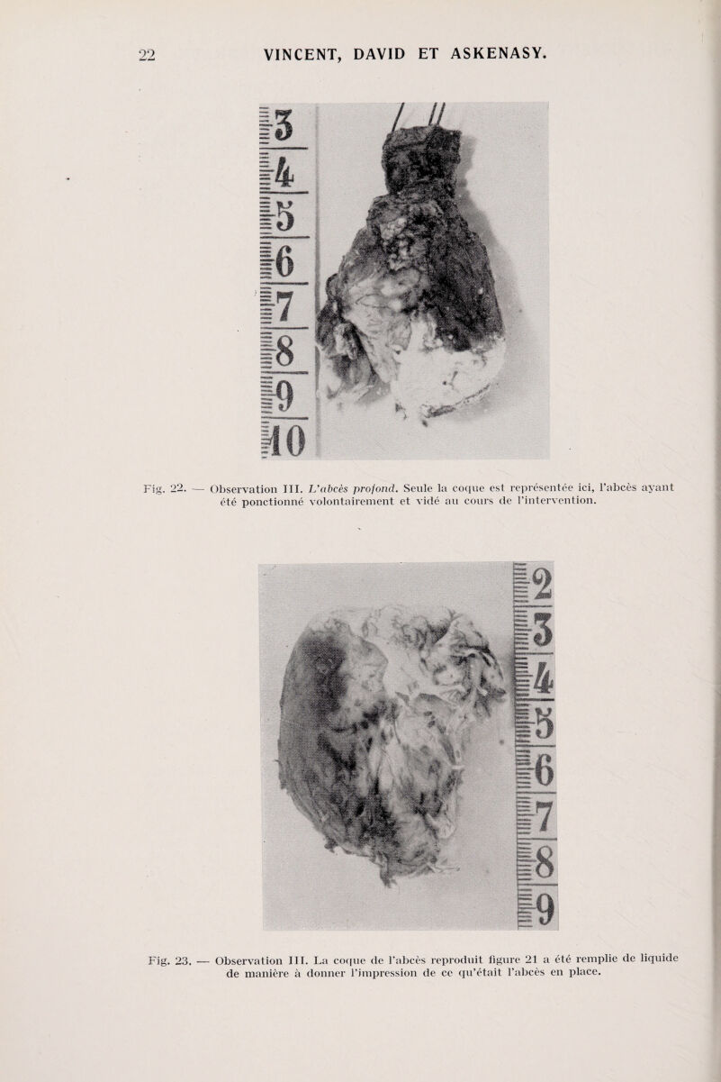 Fig. 22. — Observation III. L’abcès profond. Seule la coque est représentée ici, l’abcès ayant été ponctionné volontairement et vidé au cours de l’intervention. Fig. 23 Obsei’vation III. La coque de l’abcès reproduit figure 21 a été remplie de liquide de manière à donner l’impression de ce qu’était l’abcès en place.
