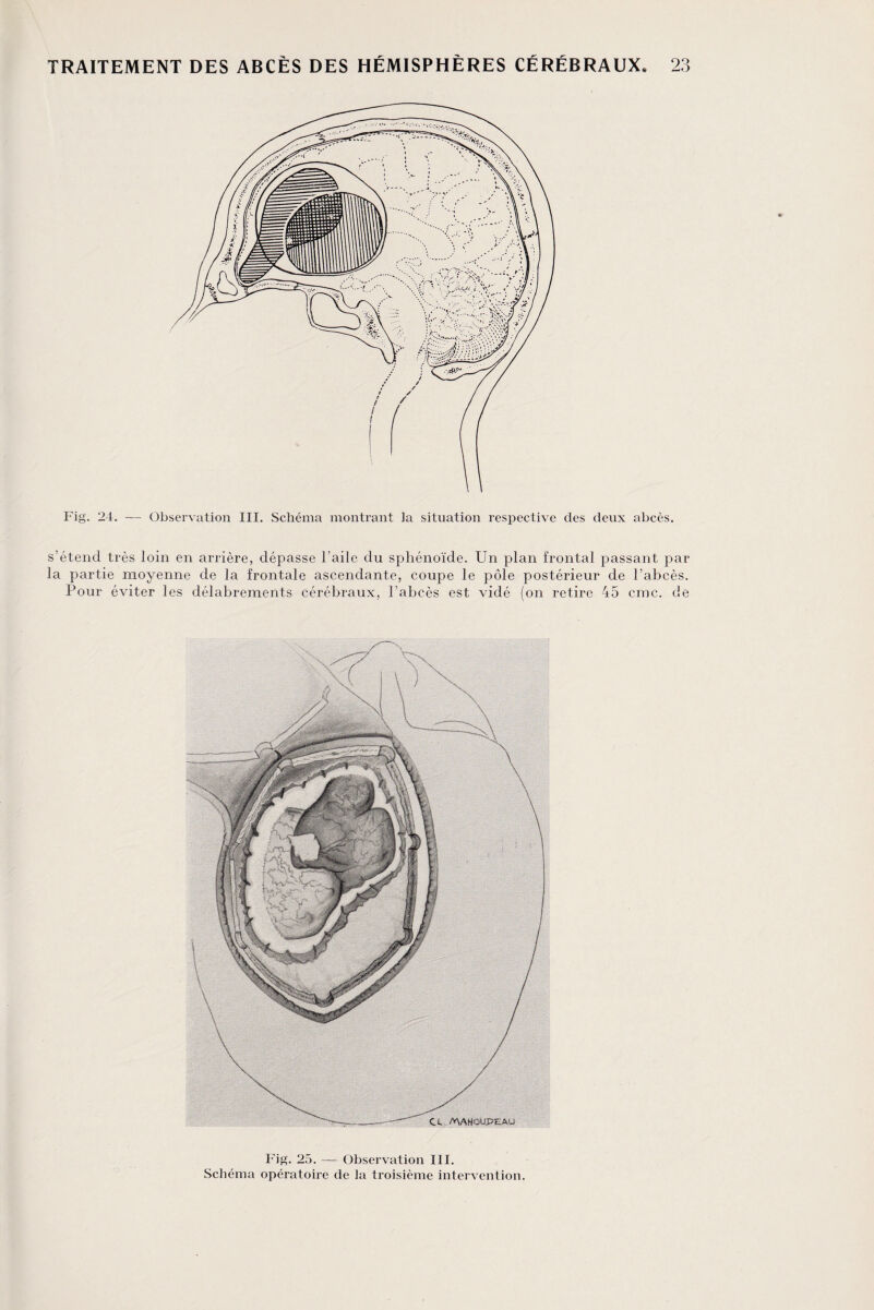 Fig'. 24. — Observation III. Schéma montrant la situation respective des deux abcès. s’étend très loin en arrière, dépasse l’aile du sphénoïde. Un plan frontal passant par la partie moyenne de la frontale ascendante, coupe le pôle postérieur de l’abcès. Pour éviter les délabrements cérébraux, l’abcès est vidé (on retire 45 cmc. de Fig. 25. — Observation III. Schéma opératoire de la troisième intervention.