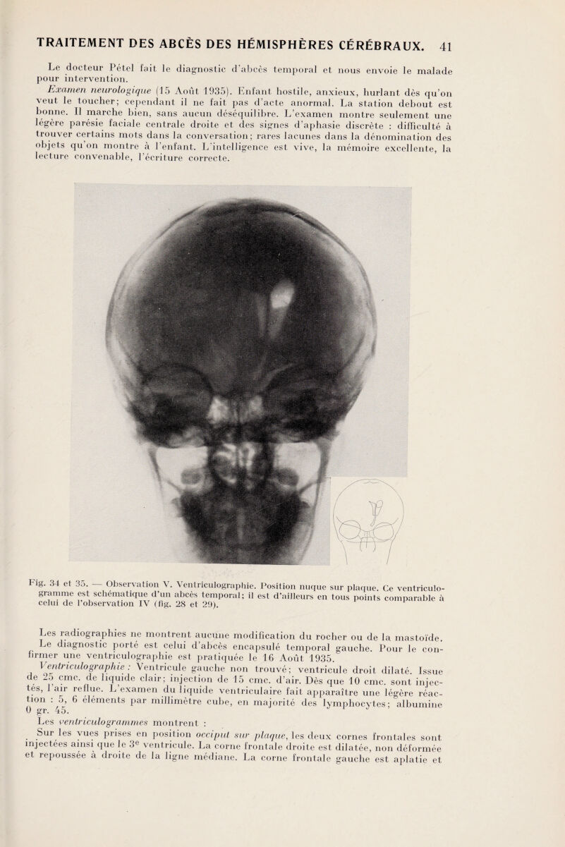 Le docteur Pétel fait le diagnostic d’abcès temporal et nous envoie le malade pour intervention. Examen neurologique (15 Août 1935). Enfant hostile, anxieux, hurlant dès qu’on veut le toucher; cependant il ne fait pas d’acte anormal. La station debout est bonne. Il marche bien, sans aucun déséquilibre. L’examen montre seulement une légère parésie faciale centrale droite et des signes d’aphasie discrète : difficulté à trouver certains mots dans la conversation; rares lacunes dans la dénomination des objets qu on montre à l’enfant. L’intelligence est vive, la mémoire excellente, la lecture convenable, l’écriture correcte. Fig. 34 et 35. — Observation V. Yentriculographie. gramme est schématique d’un abcès temporal; il celui de l’observation IV (fîg. 28 et 29). Position nuque sur plaque. Ce ventriculo- est d’ailleurs en tous points comparable à Les radiographies ne montrent aucune modification du rocher ou de la mastoïde. Le diagnostic porté est celui d’abcès encapsulé temporal gauche. Pour le con¬ firmer une ventriculographie est pratiquée le 16 Août 1935. Ventriculographie : Ventricule gauche non trouvé; ventricule droit dilaté. Issue de 25 cmc. de liquide clair; injection de 15 cmc. d’air. Dès que 10 cmc. sont injec¬ tes, 1 air rel ue. L’examen du liquide ventriculaire fait apparaître une légère réac¬ tion : 5, 6 éléments par millimètre cube, en majorité des lymphocytes; albumine 0 gr. 45. Les o entriculo grammes montrent : . Sur les vues prises en position occiput sur plaque, les deux cornes frontales sont injectées ainsi que le 3e ventricule. La corne frontale droite est dilatée, non déformée et repoussée à droite de la ligne médiane. La corne frontale gauche est aplatie et