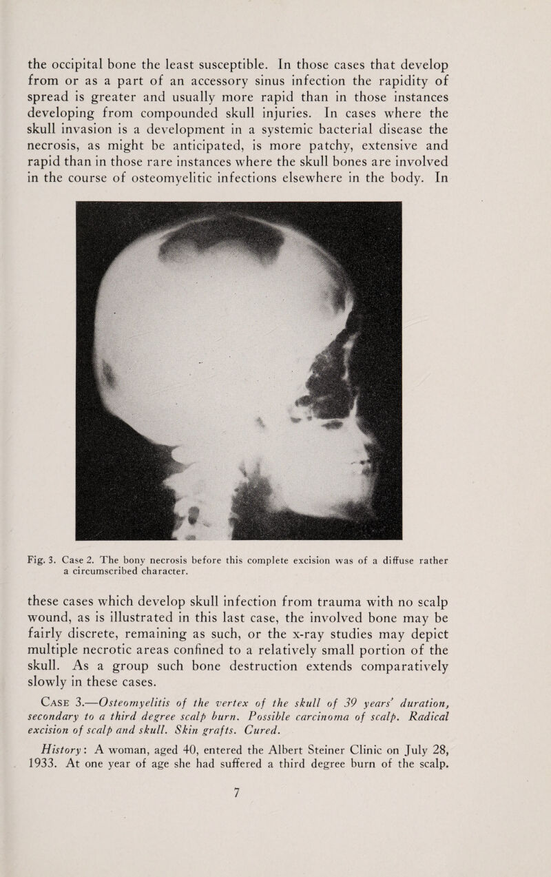 the occipital bone the least susceptible. In those cases that develop from or as a part of an accessory sinus infection the rapidity of spread is greater and usually more rapid than in those instances developing from compounded skull injuries. In cases where the skull invasion is a development in a systemic bacterial disease the necrosis, as might be anticipated, is more patchy, extensive and rapid than in those rare instances where the skull bones are involved in the course of osteomyelitic infections elsewhere in the body. In Fig. 3. Case 2. The bony necrosis before this complete excision was of a diffuse rather a circumscribed character. these cases which develop skull infection from trauma with no scalp wound, as is illustrated in this last case, the involved bone may be fairly discrete, remaining as such, or the x-ray studies may depict multiple necrotic areas confined to a relatively small portion of the skull. As a group such bone destruction extends comparatively slowly in these cases. Case 3.—-Osteomyelitis of the vertex of the skull of 39 years' duration, secondary to a third degree scalp burn. Possible carcinoma of scalp. Radical excision of scalp and skull. Skin grafts. Cured. History: A woman, aged 40, entered the Albert Steiner Clinic on July 28, 1933. At one year of age she had suffered a third degree burn of the scalp.