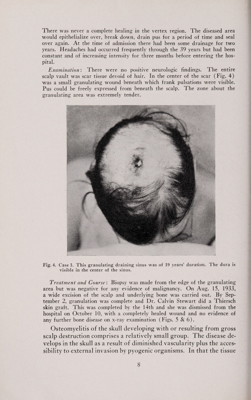 There was never a complete healing in the vertex region. The diseased area would epithelialize over, break down, drain pus for a period of time and seal over again. At the time of admission there had been some drainage for two years. Headaches had occurred frequently through the 39 years but had been constant and of increasing intensity for three months before entering the hos¬ pital. Examination: There were no positive neurologic findings. The entire scalp vault was scar tissue devoid of hair. In the center of the scar (Fig. 4) was a small granulating wound beneath which frank pulsations were visible. Pus could be freely expressed from beneath the scalp. The zone about the granulating area was extremely tender. Fig. 4. Case3. This granulating draining sinus was of 39 years’ duration. The dura is visible in the center of the sinus. Treatment and Course: Biopsy was made from the edge of the granulating area but was negative for any evidence of malignancy. On Aug. 15, 1933, a wide excision of the scalp and underlying bone was carried out. By Sep¬ tember 2, granulation was complete and Dr. Calvin Stewart did a Thiersch skin graft. This was completed by the 14th and she was dismissed from the hospital on October 10, with a completely healed wound and no evidence of any further bone disease on x-ray examination (Figs. 5 & 6). Osteomyelitis of the skull developing with or resulting from gross scalp destruction comprises a relatively small group. The disease de¬ velops in the skull as a result of diminished vascularity plus the acces¬ sibility to external invasion by pyogenic organisms. In that the tissue