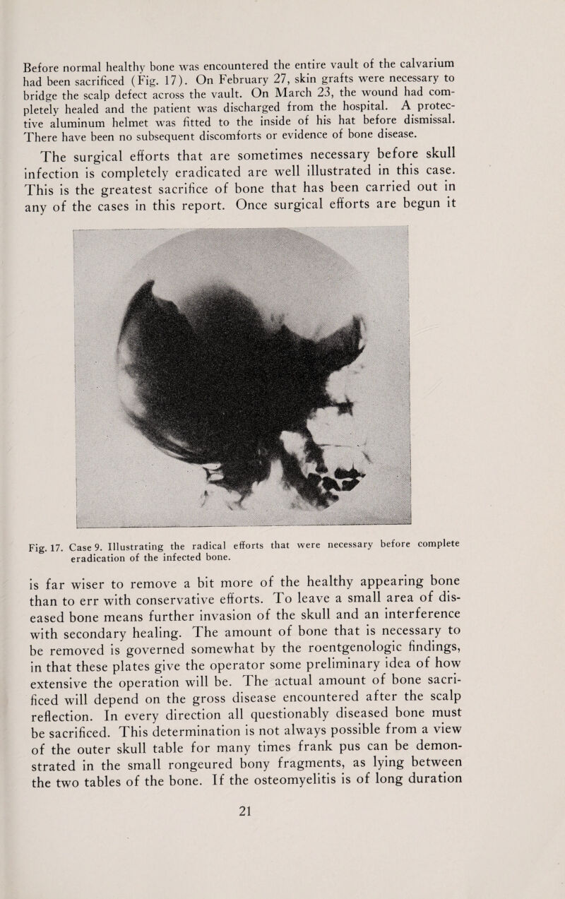 Before normal healthy bone was encountered the entire vault of the calvarium had been sacrificed (Fig. 17). On February 27, skin grafts were necessary to bridge the scalp defect across the vault. On March 23, the wound had com¬ pletely healed and the patient was discharged from the hospital. A protec¬ tive aluminum helmet was fitted to the inside of his hat before dismissal. There have been no subsequent discomforts or evidence of bone disease. The surgical efforts that are sometimes necessary before skull infection is completely eradicated are well illustrated in this case. This is the greatest sacrifice of bone that has been carried out in any of the cases in this report. Once surgical efforts are begun it Fig. 17. Case 9. Illustrating the radical efforts that were necessary before complete eradication of the infected bone. is far wiser to remove a bit more of the healthy appearing bone than to err with conservative efforts. T o leave a small area of dis¬ eased bone means further invasion of the skull and an interference with secondary healing. The amount of bone that is necessary to be removed is governed somewhat by the roentgenologic findings, in that these plates give the operator some preliminary idea of how extensive the operation will be. The actual amount of bone sacri¬ ficed will depend on the gross disease encountered after the scalp reflection. In every direction all questionably diseased bone must be sacrificed. T his determination is not always possible from a view of the outer skull table for many times frank pus can be demon¬ strated in the small rongeured bony fragments, as lying between the two tables of the bone. If the osteomyelitis is of long duration