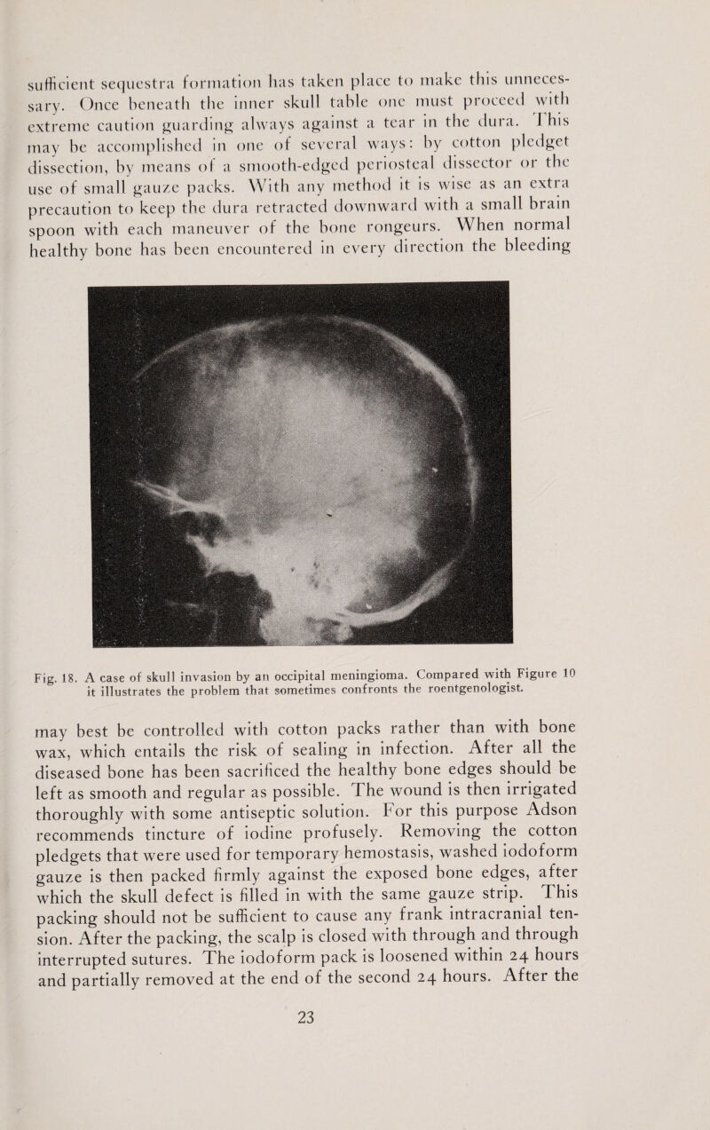 sufficient sequestra formation has taken place to make this unneces¬ sary. Once beneath the inner skull table one must proceed with extreme caution guarding always against a tear in the dura. I his may be accomplished in one of several ways: by cotton pledget dissection, by means of a smooth-edged periosteal dissector or the use of small gauze packs. With any method it is wise as an extra precaution to keep the dura retracted downward with a small brain spoon with each maneuver of the bone rongeurs. When normal healthy bone has been encountered in every direction the bleeding Fig. 18. A case of skull invasion by an occipital meningioma. Compared with Figure 10 it illustrates the problem that sometimes confronts the roentgenologist may best be controlled with cotton packs rather than with bone wax, which entails the risk of sealing in infection. After all the diseased bone has been sacrificed the healthy bone edges should be left as smooth and regular as possible, f he wound is then irrigated thoroughly with some antiseptic solution. For this purpose Adson recommends tincture of iodine profusely. Removing the cotton pledgets that were used for temporary hemostasis, washed iodoform gauze is then packed firmly against the exposed bone edges, after which the skull defect is filled in with the same gauze strip.. This packing should not be sufficient to cause any frank intracranial ten¬ sion. After the packing, the scalp is closed with through and through interrupted sutures. I he iodoform pack is loosened within 24 hours and partially removed at the end of the second 24 hours. After the