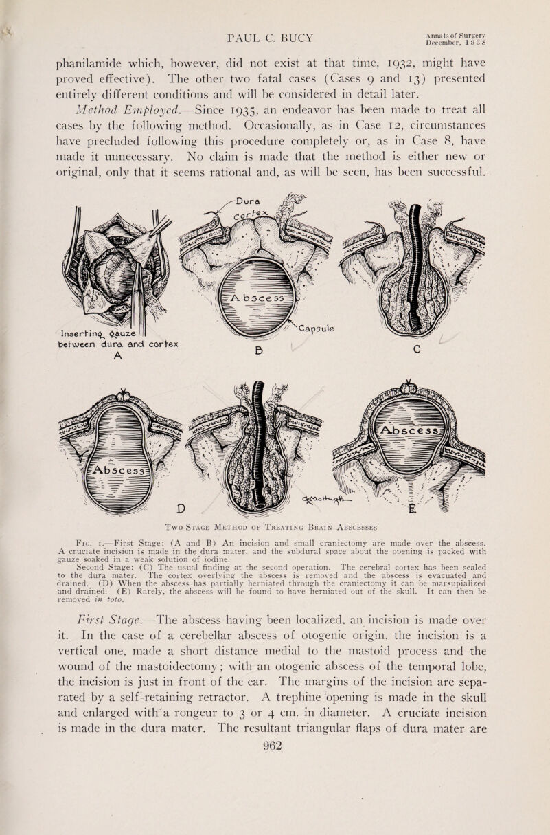 December, 11) 3 8 phanilamide which, however, did not exist at that time, 1932, might have proved eflfective). The other two fatal cases (Cases 9 and 13) presented entirely different conditions and will be considered in detail later. Method Employed.-—Since 1935, an endeavor has been made to treat all cases by the following method. Occasionally, as in Case 12, circumstances have precluded following this procedure completely or, as in Case 8, have made it unnecessary. No claim is made that the method is either new or original, only that it seems rational and, as will be seen, has been successful. Two-Stage Method of Treating Brain Abscesses Fig. I.—First Stage: (A and B) An incision and small craniectomy are made over the abscess. A cruciate incision is made in the dura mater, and the subdural space about the opening is packed with gauze soaked in a weak solution of iodine. Second Stage: (C) The usual finding at the second operation. The cerebral cortex has been sealed to the dura mater. The cortex overlying the abscess is removed and the abscess is evacuated and drained. (D) When the abscess has partially herniated through the craniectomy it can be marsupialized and drained. (E) Rarely, the abscess will be found to have herniated out of the skull. It can then be removed in toto. First Stage.—The abscess having been localized, an incision is made over it. In the case of a cerebellar abscess of otogenic origin, the incision is a vertical one, made a short distance medial to the mastoid process and the wound of the mastoidectomy; with an otogenic abscess of the temporal lobe, the incision is just in front of the ear. The margins of the incision are sepa¬ rated by a self-retaining retractor. A trephine opening is made in the skull and enlarged witha rongeur to 3 or 4 cm. in diameter. A cruciate incision is made in the dura mater. The resultant triangular flaps of dura mater are 962