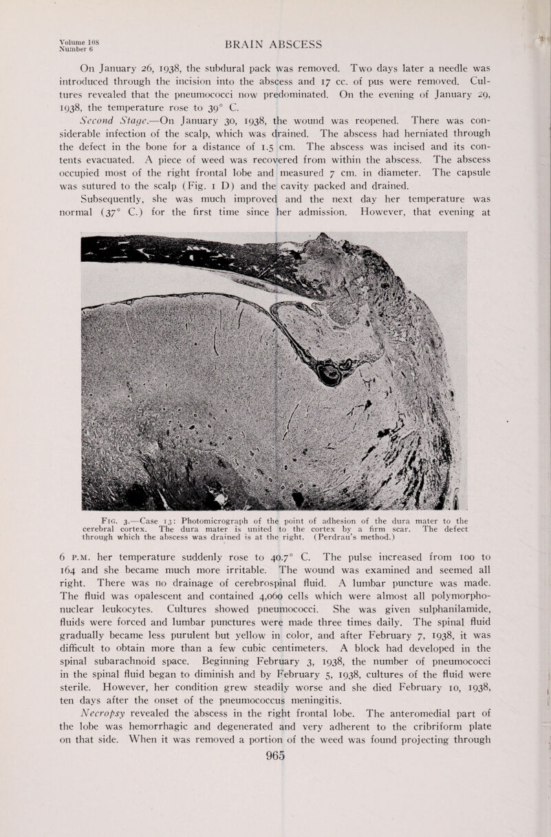 Number 0 BRAIN ABSCESS On January 26, 1938, the subdural pack was removed. Two days later a needle was introduced through the incision into the abscess and 17 cc. of pus were removed. Cul¬ tures revealed that the pneumococci now predominated. On the evening of January 29, 1938, the temperature rose to 39° C. Second Stage.—On January 30, 1938, the wound was reopened. There was con¬ siderable infection of the scalp, which was drained. The abscess had herniated through the defect in the bone for a distance of 1.5 cm. The abscess was incised and its con¬ tents evacuated. A piece of weed was recovered from within the abscess. The abscess occupied most of the right frontal lobe and measured 7 cm. in diameter. The capsule was sutured to the scalp (Fig. i D) and the cavity packed and drained. Subsequently, she was much improved and the next day her temperature was normal (37° C.) for the first time since her admission. However, that evening at Fig. 3.—Case 13; Photomicrograph of the point of adhesion of the dura mater to the cerebral cortex. The dura mater is united to the cortex by a firm scar. The defect through which the abscess was drained is at the right. (Perdrau’s method.) 6 P.M. her temperature suddenly rose to 40.7° C. The pulse increased from 100 to 164 and she became much more irritable. The wound was examined and seemed all right. There was no drainage of cerebrospinal fluid. A lumbar puncture was made. The fluid was opalescent and contained 4,060 cells which were almost all polymorpho¬ nuclear leukocytes. Cultures showed pneumococci. She was given sulphanilamide, fluids were forced and lumbar punctures were made three times daily. The spinal fluid gradually became less purulent but yellow in color, and after February 7, 1938, it was difficult to obtain more than a few cubic centimeters. A block had developed in the spinal subarachnoid space. Beginning February 3, 1938, the number of pneumococci in the spinal fluid began to diminish and by February 5, 1938, cultures of the fluid were sterile. However, her condition grew steadily worse and she died February 10, 1938, ten days after the onset of the pneumococcus meningitis. Necropsy revealed the abscess in the right frontal lobe. The anteromedial part of the lobe was hemorrhagic and degenerated and very adherent to the cribriform plate on that side. When it was removed a portion of the weed was found projecting through