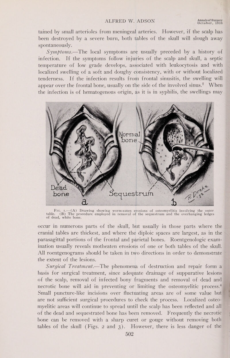 October, 1938 tained by small arterioles from meningeal arteries. However, if the scalp has been destroyed by a severe burn, both tables of the skull will slough away spontaneously. Symptoms.—The local symptoms are usually preceded by a history of infection. If the symptoms follow injuries of the scalp and skull, a septic temperature of low grade develops, associated with leukocytosis and with localized swelling of a soft and doughy consistency, with or without localized tenderness. If the infection results from frontal sinusitis, the swelling will appear over the frontal bone, usually on the side of the involved sinus.7 When the infection is of hematogenous origin, as it is in syphilis, the swellings may Fig. i.— (A) Drawing showing worm-eaten erosions of osteomyelitis involving the outer table. (B) The procedure employed in removal of the sequestrum and the overhanging ledges of dead, white bone. occur in numerous parts of the skull, but usually in those parts where the cranial tables are thickest, and where the diploic spaces are largest, as in the parasagittal portions of the frontal and parietal bones. Roentgenologic exam¬ ination usually reveals motheaten erosions of one or both tables of the skull. All roentgenograms should be taken in two directions in order to demonstrate the extent of the lesions. Surgical Treatment.—The phenomena of destruction and repair form a basis for surgical treatment, since adequate drainage of suppurative lesions of the scalp, removal of infected bony fragments and removal of dead and necrotic bone will aid in preventing or limiting the osteomyelitic process.4 Small puncture-like incisions over fluctuating areas are of some value but are not sufficient surgical procedures to check the process. Localized osteo¬ myelitic areas will continue to spread until the scalp has been reflected and all of the dead and sequestrated bone has been removed. Frequently the necrotic bone can be removed with a sharp curet or gouge without removing both tables of the skull (Figs. 2 and 3). However, there is less danger of the