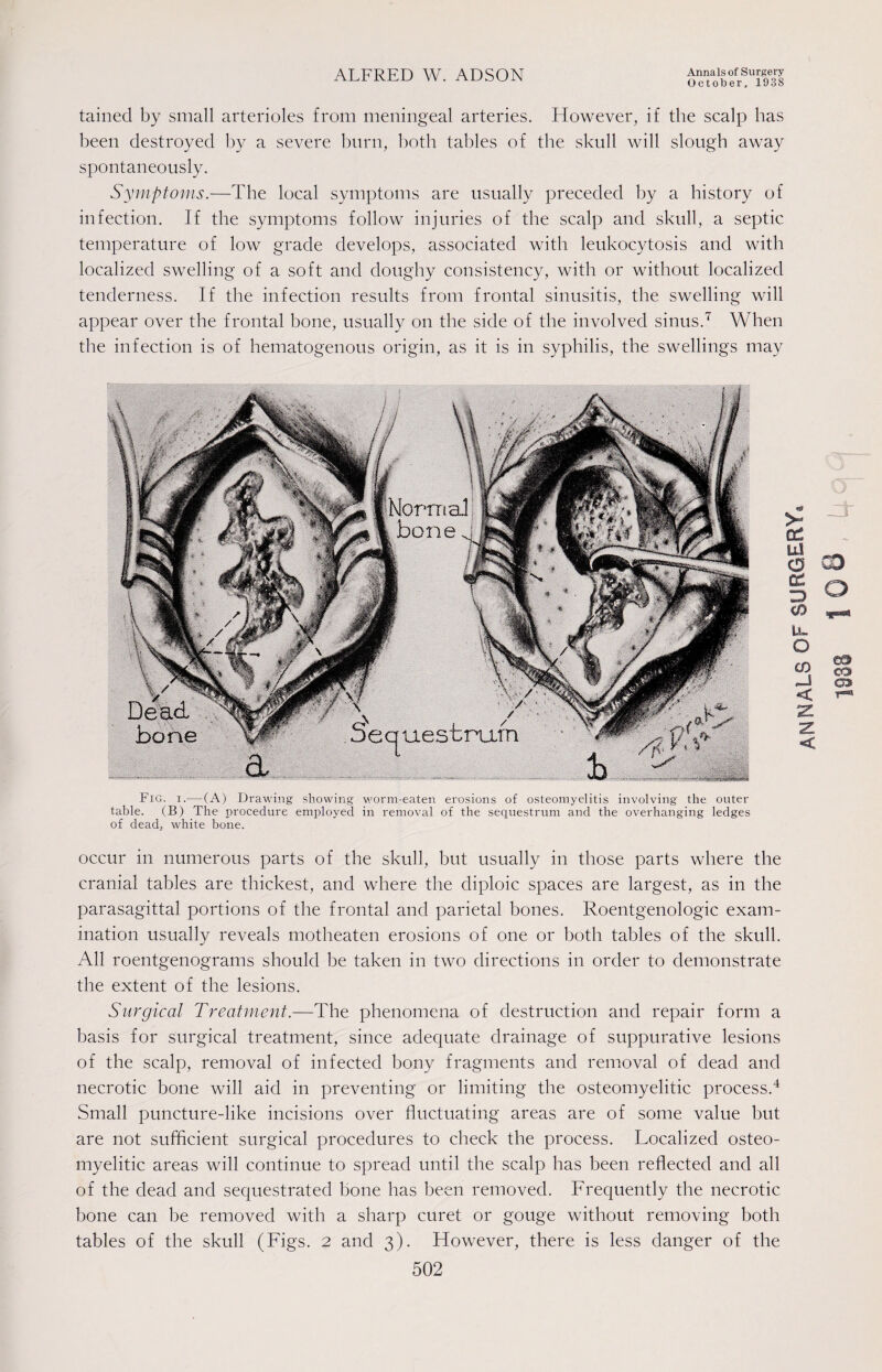 October, 1938 tained by small arterioles from meningeal arteries. However, if the scalp has been destroyed by a severe burn, both tables of the skull will slough away spontaneously. Symptoms.—The local symptoms are usually preceded by a history of infection. If the symptoms follow injuries of the scalp and skull, a septic temperature of low grade develops, associated with leukocytosis and with localized swelling of a soft and doughy consistency, with or without localized tenderness. If the infection results from frontal sinusitis, the swelling will appear over the frontal bone, usually on the side of the involved sinus.7 When the infection is of hematogenous origin, as it is in syphilis, the swellings may Fig. i.— (A) Drawing showing worm-eaten erosions of osteomyelitis involving the outer table. (B) The procedure employed in removal of the sequestrum and the overhanging ledges of dead, white bone. occur in numerous parts of the skull, but usually in those parts where the cranial tables are thickest, and where the diploic spaces are largest, as in the parasagittal portions of the frontal and parietal bones. Roentgenologic exam¬ ination usually reveals motheaten erosions of one or both tables of the skull. All roentgenograms should be taken in two directions in order to demonstrate the extent of the lesions. Surgical Treatment.—The phenomena of destruction and repair form a basis for surgical treatment, since adequate drainage of suppurative lesions of the scalp, removal of infected bony fragments and removal of dead and necrotic bone will aid in preventing or limiting the osteomyelitic process.4 Small puncture-like incisions over fluctuating areas are of some value but are not sufficient surgical procedures to check the process. Localized osteo¬ myelitic areas will continue to spread until the scalp has been reflected and all of the dead and sequestrated bone has been removed. Frequently the necrotic bone can be removed with a sharp curet or gouge without removing both tables of the skull (Figs. 2 and 3). However, there is less danger of the