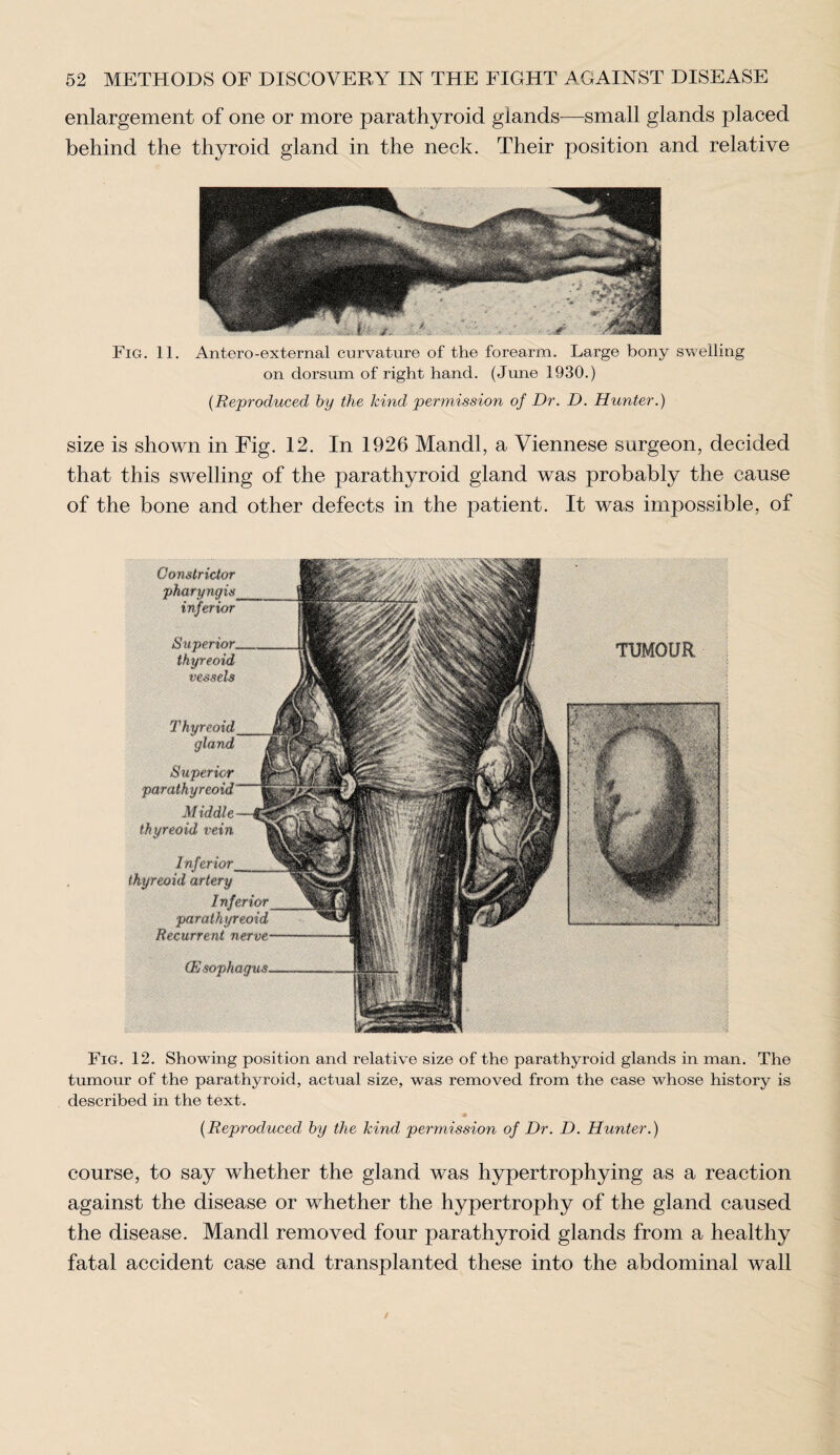 enlargement of one or more parathyroid glands—small glands placed behind the thyroid gland in the neck. Their position and relative Fig. 11. Antero-external curvature of the forearm. Large bony swelling on dorsum of right hand. (June 1930.) (Reproduced by the kind permission of Dr. D. Hunter.) size is shown in Fig. 12. In 1926 Mandl, a Viennese surgeon, decided that this swelling of the parathyroid gland was probably the cause of the bone and other defects in the patient. It was impossible, of Constrictor pharyngis inferior Superior. thyreoid vessels gland Superior parathyreoid Middle vein Inferior• thyreoid artery Inferior parathyreoid Recurrent ner-m~— OSsopha, TUMOUR Fig. 12. Showing position and relative size of the parathyroid glands in man. The tumour of the parathyroid, actual size, was removed from the case whose history is described in the text. (Reproduced by the kind permission of Dr. D. Hunter.) course, to say whether the gland was hypertrophying as a reaction against the disease or whether the hypertrophy of the gland caused the disease. Mandl removed four parathyroid glands from a healthy fatal accident case and transplanted these into the abdominal wall