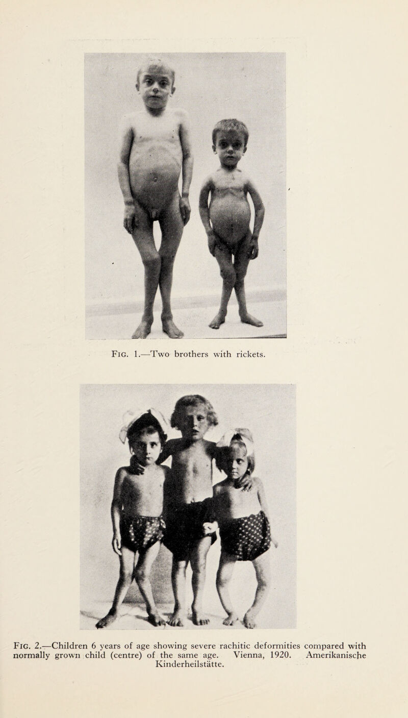 Fig. 1.—Two brothers with rickets. Fig. 2.—Children 6 years of age showing severe rachitic deformities compared with normally grown child (centre) of the same age. Vienna, 1920. Amerikanische Kinderheilstatte.