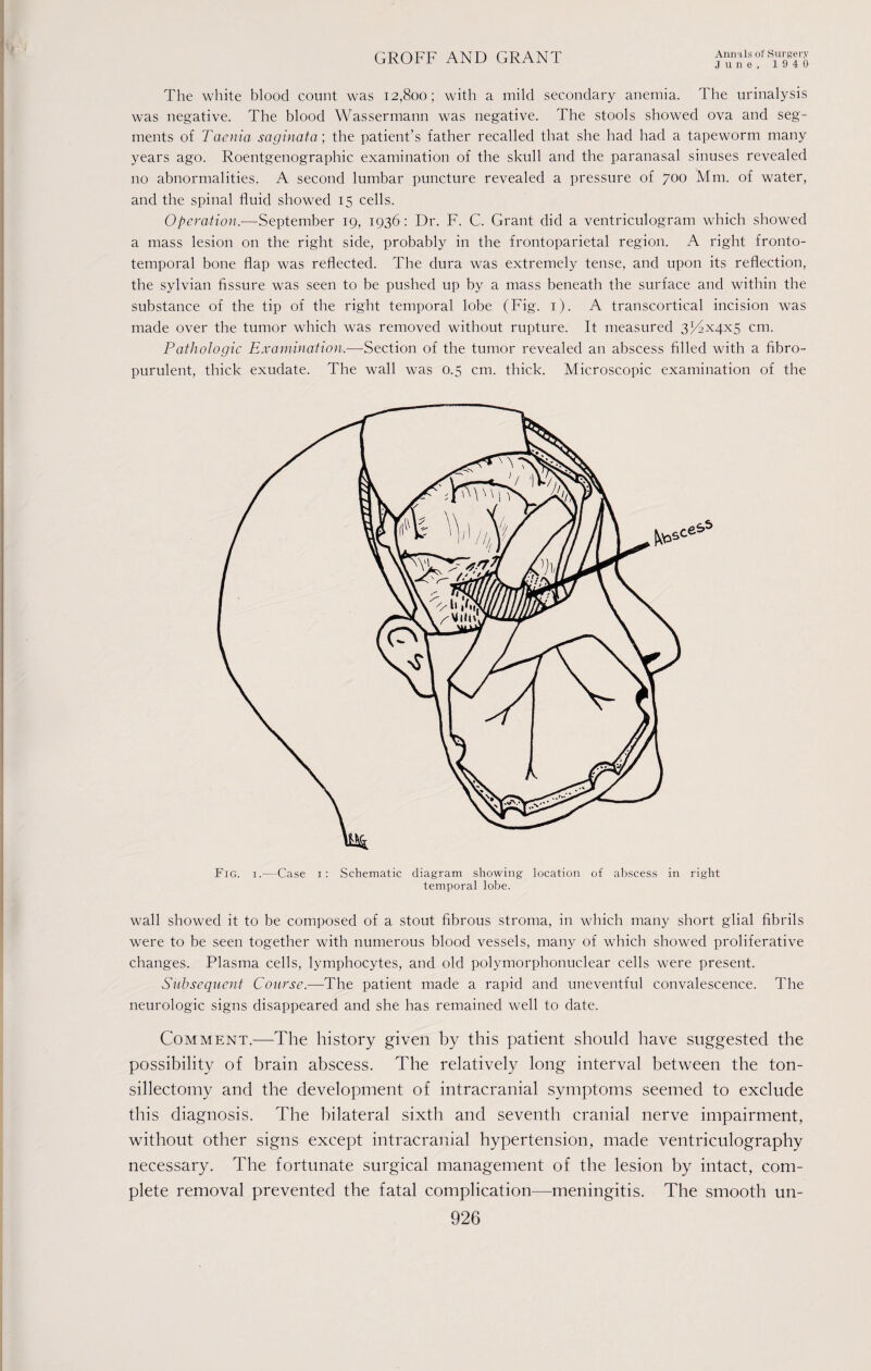 June, 1940 The white blood count was 12,800; with a mild secondary anemia. The urinalysis was negative. The blood Wassermann was negative. The stools showed ova and seg¬ ments of Taenia saginata; the patient’s father recalled that she had had a tapeworm many years ago. Roentgenographic examination of the skull and the paranasal sinuses revealed no abnormalities. A second lumbar puncture revealed a pressure of 700 Mm. of water, and the spinal fluid showed 15 cells. Operation.—September 19, 1936 : Dr. F. C. Grant did a ventriculogram which showed a mass lesion on the right side, probably in the frontoparietal region. A right fronto¬ temporal bone flap was reflected. The dura was extremely tense, and upon its reflection, the sylvian fissure was seen to be pushed up by a mass beneath the surface and within the substance of the tip of the right temporal lobe (Fig. 1). A transcortical incision was made over the tumor which was removed without rupture. It measured 372x4x5 cm. Pathologic Examination.-—'Section of the tumor revealed an abscess filled with a fibro- purulent, thick exudate. The wall was 0.5 cm. thick. Microscopic examination of the Fig. i.—Case 1: Schematic diagram, showing location of abscess in right temporal lobe. wall showed it to be composed of a stout fibrous stroma, in which many short glial fibrils were to be seen together with numerous blood vessels, many of which showed proliferative changes. Plasma cells, lymphocytes, and old polymorphonuclear cells were present. Subsequent Course.—The patient made a rapid and uneventful convalescence. The neurologic signs disappeared and she has remained well to date. Comment.—The history given by this patient should have suggested the possibility of brain abscess. The relatively long interval between the ton¬ sillectomy and the development of intracranial symptoms seemed to exclude this diagnosis. The bilateral sixth and seventh cranial nerve impairment, without other signs except intracranial hypertension, made ventriculography necessary. The fortunate surgical management of the lesion by intact, com¬ plete removal prevented the fatal complication—meningitis. The smooth un- 926