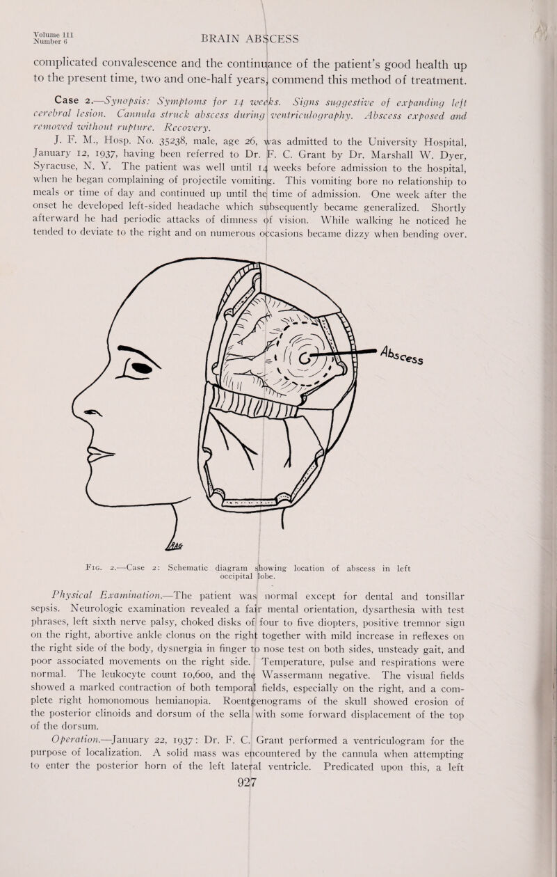 Number 6 BRAIN ABSCESS complicated convalescence and the continuance of the patient’s good health up to the present time, two and one-half years,] commend this method of treatment. Case 2.—Synopsis: Symptoms for 14 weeks. Signs suggestive of expanding left cerebral lesion. Cannula struck abscess during ventriculography. Abscess exposed and removed without rupture. Recovery. J. F. M., Hosp. No. 35238, male, age 26, was admitted to the University Hospital, January 12, 1937, having been referred to Dr. F. C. Grant by Dr. Marshall W. Dyer, Syracuse, N. Y. The patient was well until 14 weeks before admission to the hospital, when he began complaining of projectile vomiting. This vomiting bore no relationship to meals or time of day and continued up until the time of admission. One week after the onset he developed left-sided headache which subsequently became generalized. Shortly afterward he had periodic attacks of dimness q>f vision. While walking he noticed he tended to deviate to the right and on numerous occasions became dizzy when bending over. Ak Fig. 2.—Case Schematic diagram showing location of abscess in left occipital lobe. Physical Examination.—The patient was normal except for dental and tonsillar sepsis. Neurologic examination revealed a fair mental orientation, dysarthesia with test phrases, left sixth nerve palsy, choked disks of four to five diopters, positive tremnor sign on the right, abortive ankle clonus on the right together with mild increase in reflexes on the right side of the body, dysnergia in finger to nose test on both sides, unsteady gait, and poor associated movements on the right side. Temperature, pulse and respirations were normal. The leukocyte count 10,600, and the Wassermann negative. The visual fields showed a marked contraction of both temporal fields, especially on the right, and a com¬ plete right homonomous hemianopia. Roentgenograms of the skull showed erosion of the posterior clinoids and dorsum of the sella with some forward displacement of the top of the dorsum. Operation.—January 22, 1937: Dr. F. C. Grant performed a ventriculogram for the purpose of localization. A solid mass was encountered by the cannula when attempting to enter the posterior horn of the left lateral ventricle. Predicated upon this, a left