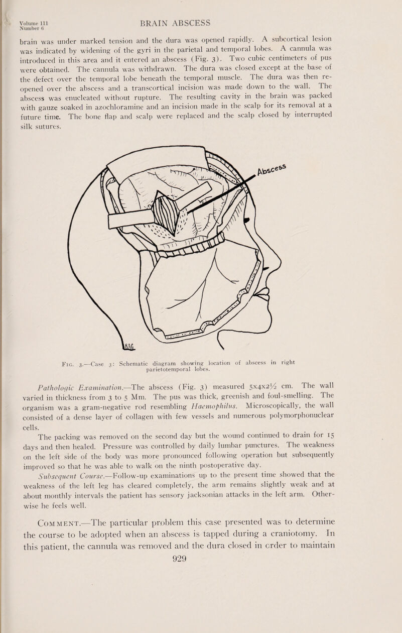 Number 6 brain was under marked tension and the dura was opened rapidly. A subcoitical lesion was indicated by widening of the gyri in the parietal and temporal lobes. A cannula was introduced in this area and it entered an abscess (Fig. 3)- Two cubic centimeters of pus were obtained. The cannula was withdrawn. The dura was closed except at the base of the defect over the temporal lobe beneath the temporal muscle. T he dura was then re¬ opened over the abscess and a transcortical incision was made down to the wall. The abscess was enucleated without rupture. The resulting cavity in the brain was packed with gauze soaked in azochloramine and an incision made in the scalp for its removal at a future time. The bone flap and scalp were replaced and the scalp closed by interrupted silk sutures. FIG. 3.—Case 3: Schematic diagram showing location of abscess in right parietotemporal lobes. Pathologic Examination.-—The abscess (Fig. 3) measured 5x4x214 cm. The wall varied in thickness from 3 to 5 Mm. The pus was thick, greenish and foul-smelling. The organism was a gram-negative rod resembling Haemophilus. Microscopically, the wall consisted of a dense layer of collagen with few vessels and numerous polymorphonuclear cells. The packing was removed on the second day but the wound continued to drain for 15 days and then healed. Pressure was controlled by daily lumbar punctures. The weakness on the left side of the body was more pronounced following operation but subsequently improved so that he was able to walk on the ninth postoperative day. Subsequent Course.—Follow-up examinations up to the present time showed that the weakness of the left leg has cleared completely, the arm remains slightly weak and at about monthly intervals the patient has sensory jacksonian attacks in the left arm. Other¬ wise he feels well. Comment.—The particular problem this case presented was to determine the course to be adopted when an abscess is tapped during a craniotomy. In this patient, the cannula was removed and the dura closed in order to maintain