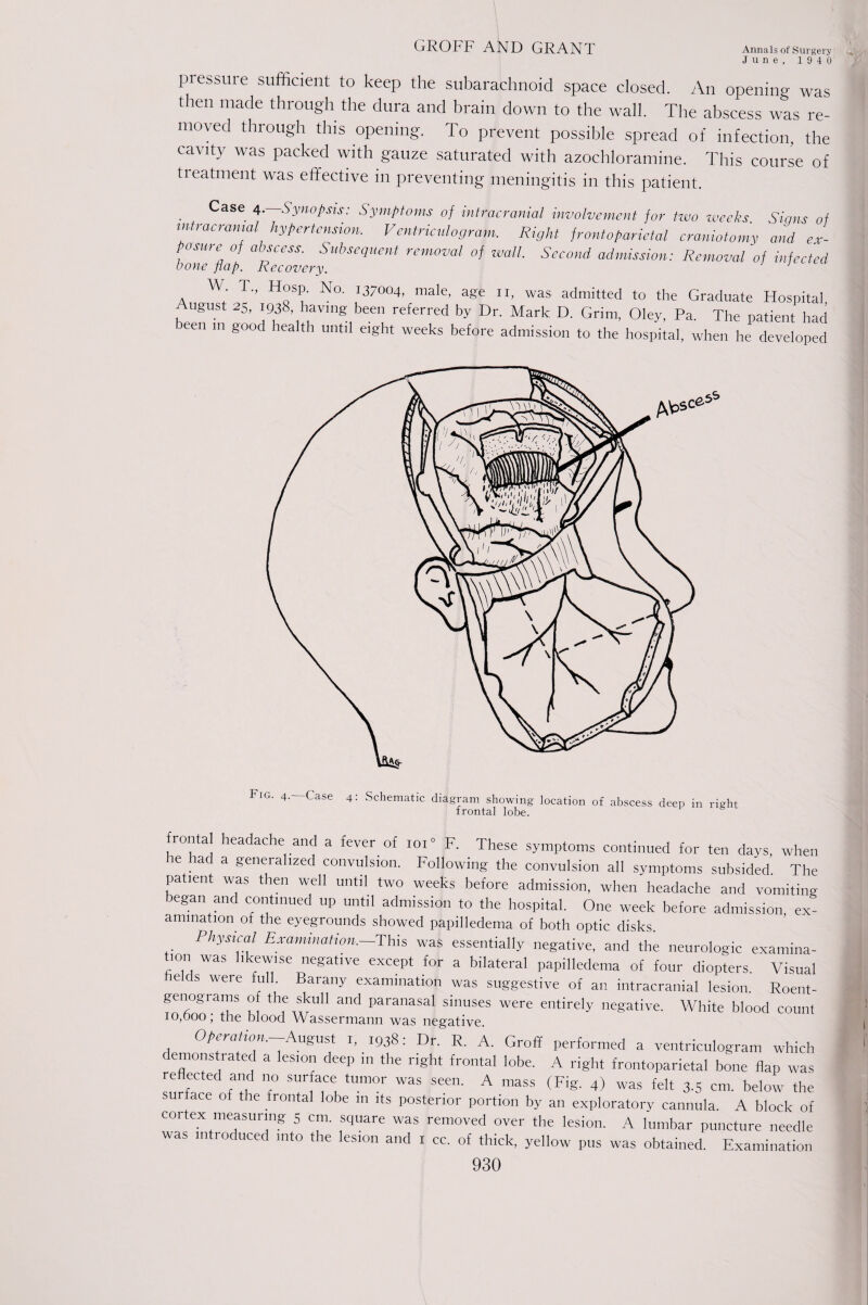 June, 1940 pressure sufficient to keep the subarachnoid space closed. An opening was then made through the dura and brain down to the wall. The abscess was re¬ moved through this opening. To prevent possible spread of infection, the cavity was packed with gauze saturated with azochloramine. This course of tieatment was effective in preventing meningitis in this patient. Case 4.—Synopsis: Symptoms of intracranial involvement for two weeks. Signs of intracranial hypertension. Ventriculogram. Right frontoparietal craniotomy and ex¬ posure of abscess. Subsequent removal of wall. Second admission: Removal of infected bone flap. Recovery. 1 W T., Hosp. No. 137004, male, age II, was admitted to the Graduate Hospital ugust 25, 1938, having been referred by Dr. Mark D. Grim, Oley, Pa. The patient had teen in good health until eight weeks before admission to the hospital, when he developed Fig. 4. Case 4: Schematic diagram showing location of abscess deep in right frontal lobe. frontal headache and a fever of ioi F. These symptoms continued for ten days, when e lad a generalized convulsion. Following the convulsion all symptoms subsided. The patient was then well until two weeks before admission, when headache and vomiting began and continued up until admission to the hospital. One week before admission ex¬ amination of the eyegrounds showed papilledema of both optic disks. Physical Examination.—This was essentially negative, and the neurologic examina¬ tion was likewise negative except for a bilateral papilledema of four diopters. Visual helds were full. Barany examination was suggestive of an intracranial lesion. Roent- genograms of the skull and paranasal sinuses were entirely negative. White blood count 10,000, the blood Wassermann was negative. Operation.-August I, 1938: Dr. R. A. Groff performed a ventriculogram which demonstrated a lesion deep in the right frontal lobe. A right frontoparietal bone flap was reflected and no surface tumor was seen. A mass (Fig. 4) was felt 3.5 cm. below the s r ace of the frontal lobe in its posterior portion by an exploratory cannula. A block of coi tex measuring- 5 cm. square was removed over the lesion. A lumbar puncture needle was introduced into the lesion and 1 cc. of thick, yellow pus was obtained. Examination