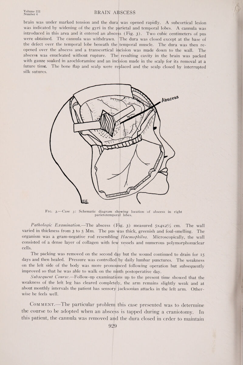 Number 6 BRAIN ABSCESS brain was under marked tension and the dura was opened rapidly. A subcortical lesion was indicated by widening of the gyri in the parietal and temporal lobes. A cannula was introduced in this area and it entered an abscess (Fig. 3). Two cubic centimeters of pus were obtained. The cannula was withdrawn. The dura was closed except at the base of the defect over the temporal lobe beneath the temporal muscle. The dura was then re¬ opened over the abscess and a transcortical incision was made down to the wall. The abscess was enucleated without rupture. The resulting cavity in the brain was packed with gauze soaked in azochloramine and an incision made in the scalp for its removal at a future time. The bone flap and scalp were replaced and the scalp closed by interrupted silk sutures. Fig. 3.—Case 3: Schematic diagram showing location of abscess in right parietotemporal lobes. Pathologic Examination.—The abscess (Fig. 3) measured 5x4x254 cm. The wall varied in thickness from 3 to 5 Mm. The pus was thick, greenish and foul-smelling. The organism was a gram-negative rod resembling Haemophilus. Microscopically, the wall consisted of a dense layer of collagen with few vessels and numerous polymorphonuclear cells. The packing was removed on the second day but the wound continued to drain for 15 days and then healed. Pressure was controlled by daily lumbar punctures. The weakness on the left side of the body was more pronounced following operation but subsequently improved so that he was able to walk on the ninth postoperative day. Subsequent Course.—Follow-up examinations up to the present time showed that the weakness of the left leg has cleared completely, the arm remains slightly weak and at about monthly intervals the patient has sensory jacksonian attacks in the left arm. Other¬ wise he feels well. Comment.—The particular problem this case presented was to determine the course to be adopted when an abscess is tapped during a craniotomy. In this patient, the cannula was removed and the dura closed in order to maintain
