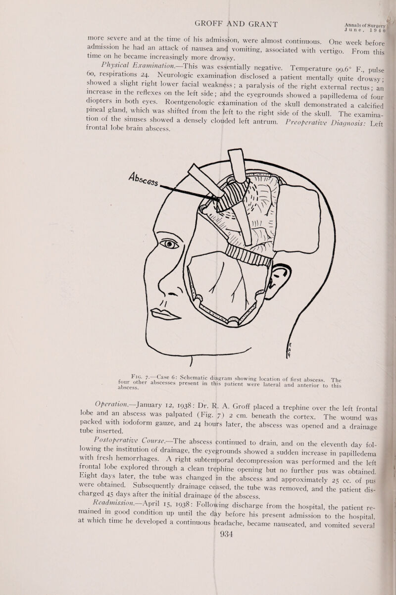 June, 1940 more severe and at the time of his admission, were almost continuous. One week before admission he had an attack of nausea and vomiting, associated with vertigo. From this time on he became increasingly more drowsy. Physical Examination.—Phis was essentially negative. Temperature 99.6° F., pulse 60, respirations 24. Neurologic examination disclosed a patient mentally quite drowsy showed a slight right lower facial weakness; a paralysis of the right external rectus • an increase m the reflexes on the left side; and the eyegrounds showed a papilledema of four diopters in both eyes. Roentgenologic examination of the skull demonstrated a calcified pineal gland, which was shifted from the left to the right side of the skull The examina t.on of the sinuses showed a densely elouded left antrum. Preoperative Diagnosis: Left frontal lobe bram abscess. Operation January 12, 1938: Dr. R. A. Groff placed a trephine over the left frontal obe and an abscess was palpated (Fig. 7) 2 cm. beneath the cortex. The wound was packed with iodoform gauze, and 24 hours later, the abscess was opened and a drainage tube inserted. Postoperative Course.—The abscess continued to drain, and on the eleventh day fol- ■' lowing the institution of drainage, the eyegrounds showed a sudden increase in papilledema with fresh hemorrhages. A right subtemporal decompression was performed and the left rontal lobe explored through a clean trephine opening but no further pus was obtained Fight days later, the tube was changed in the abscess and approximately 25 cc of pus were obtained. Subsequently drainage ceased, the tube was removed, and the patient dis¬ charged 45 days after the initial drainage of the abscess. Re admission.—April 15, 1938: Following discharge from the hospital, the patient re¬ mained m good condition up until the day before his present admission to the hospital, at which time he developed a continuous headache, became nauseated, and vomited several