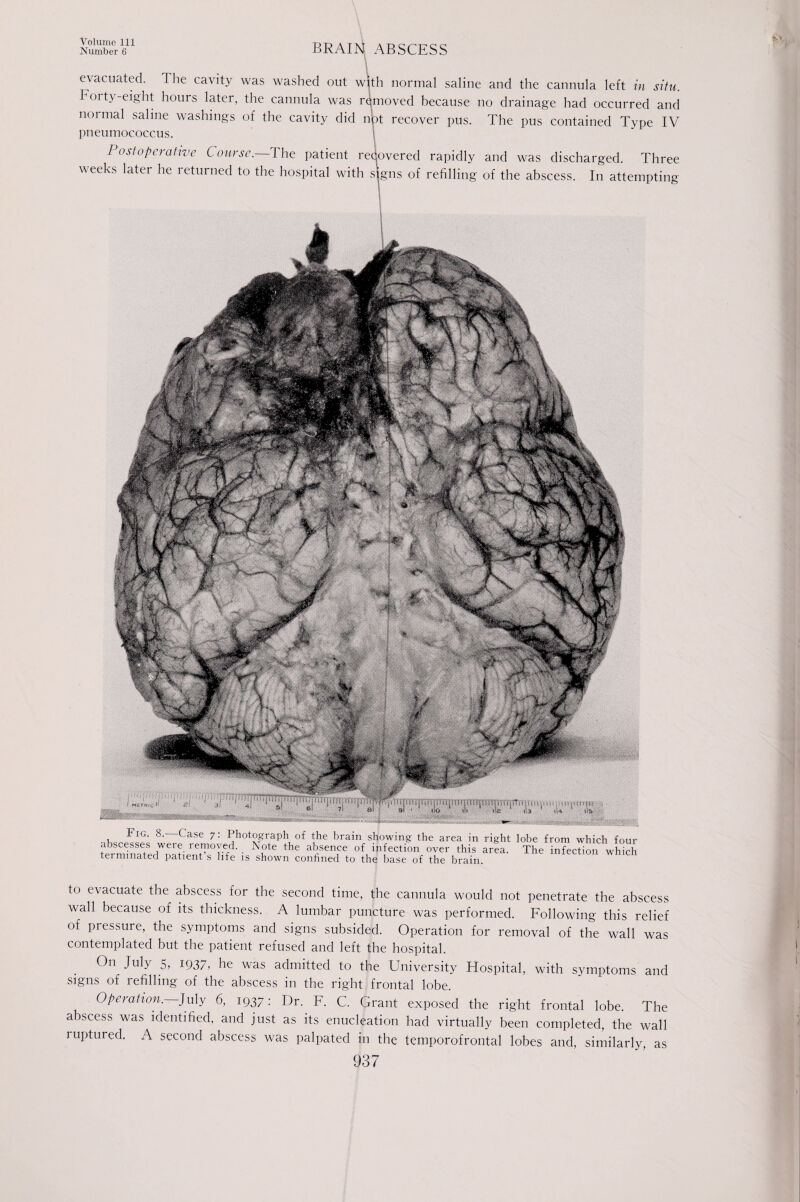 Number 6 BRAIN ABSCESS evacuated. The cavity was washed out with normal saline and the cannula left in situ. Eoit\-eight hours later, the cannula was rqmoved because no drainage had occurred and normal saline washings of the cavity did nbt recover pus. The pus contained Type IV pneumococcus. Postoperative Course.—The patient recovered rapidly and was discharged. Three weeks later he leturned to the hospital with signs of refilling of the abscess. In attempting to evacuate the abscess for the second time, the cannula would not penetrate the abscess wall because of its thickness. A lumbar puncture was performed. Following this relief of piessure, the symptoms and signs subsided. Operation for removal of the wall was contemplated but the patient refused and left the hospital. On July 5, 1937, he was admitted to the University Hospital, with symptoms and signs of refilling of the abscess in the right frontal lobe. Operation. July 6, 1937: Dr. F. C. Grant exposed the right frontal lobe. The abscess was identified, and just as its enucleation had virtually been completed, the wall ruptured. A second abscess was palpated in the temporofrontal lobes and, similarly, as 937 KF