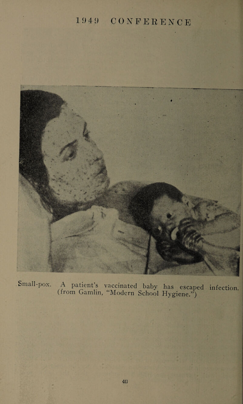 19 4!) CO 1ST F E R E N C E Small-pox. A patient’s vaccinated baby has escaped infection (from Gamlin, “Modern School Hygiene.”)
