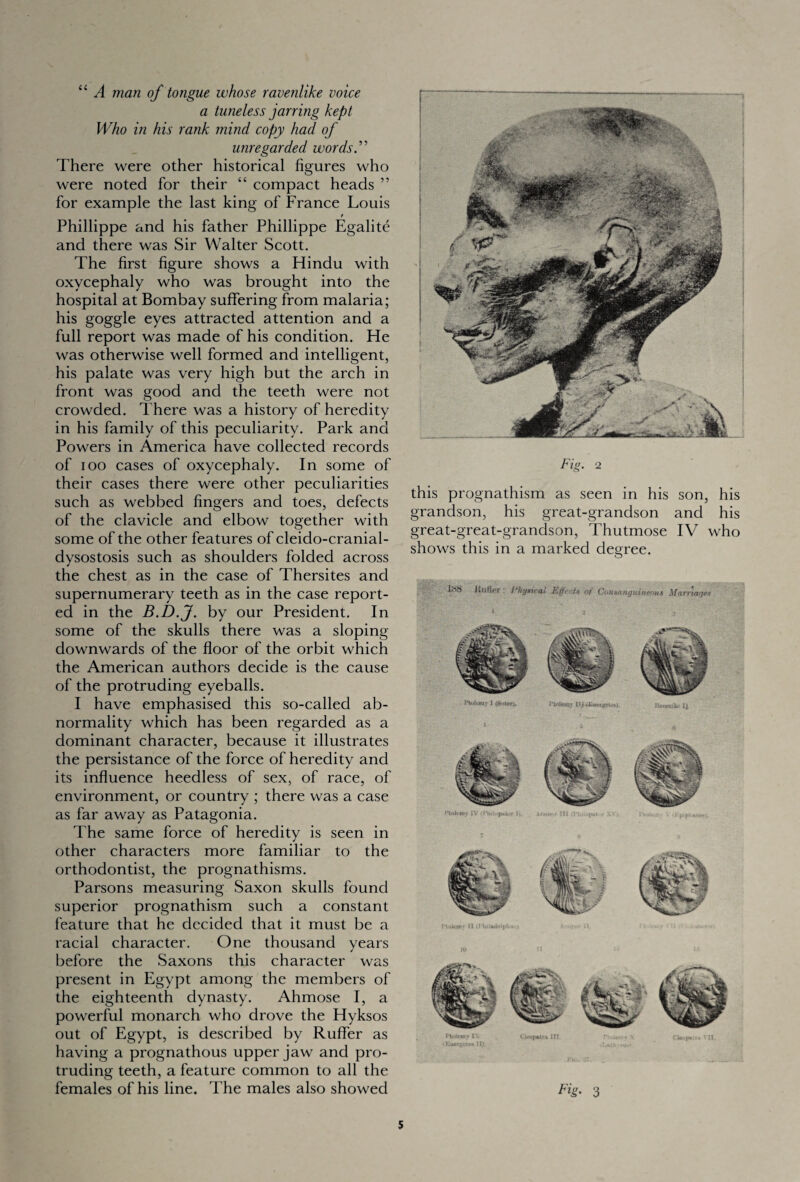 “ A man of tongue whose ravenlike voice a tuneless jarring kept Who in his rank mind copy had of unregarded words” There were other historical figures who were noted for their “ compact heads ” for example the last king of France Louis t Phillippe and his father Phillippe Egalite and there was Sir Walter Scott. The first figure shows a Hindu with oxycephaly who was brought into the hospital at Bombay suffering from malaria; his goggle eyes attracted attention and a full report was made of his condition. He was otherwise well formed and intelligent, his palate was very high but the arch in front was good and the teeth were not crowded. There was a history of heredity in his family of this peculiarity. Park and Powers in America have collected records of ioo cases of oxycephaly. In some of their cases there were other peculiarities such as webbed fingers and toes, defects of the clavicle and elbow together with some of the other features of cleido-cranial- dysostosis such as shoulders folded across the chest as in the case of Thersites and supernumerary teeth as in the case report¬ ed in the B.D.J. by our President. In some of the skulls there was a sloping downwards of the floor of the orbit which the American authors decide is the cause of the protruding eyeballs. I have emphasised this so-called ab¬ normality which has been regarded as a dominant character, because it illustrates the persistance of the force of heredity and its influence heedless of sex, of race, of environment, or country ; there was a case as far away as Patagonia. The same force of heredity is seen in other characters more familiar to the orthodontist, the prognathisms. Parsons measuring Saxon skulls found superior prognathism such a constant feature that he decided that it must be a racial character. One thousand years before the Saxons this character was present in Egypt among the members of the eighteenth dynasty. Ahmose I, a powerful monarch who drove the Hyksos out of Egypt, is described by Ruffer as having a prognathous upper jaw and pro¬ truding teeth, a feature common to all the females of his line. The males also showed Fig. 2 this prognathism as seen in his son, his grandson, his great-grandson and his great-great-grandson, Thutmose IV who shows this in a marked degree. JiutW I'hyttuai £(}t t» Contumgitiueout Marnntjex I’toiomy IN CbopMa HI. , \ cWuf.ii. V|l. Fig- 3