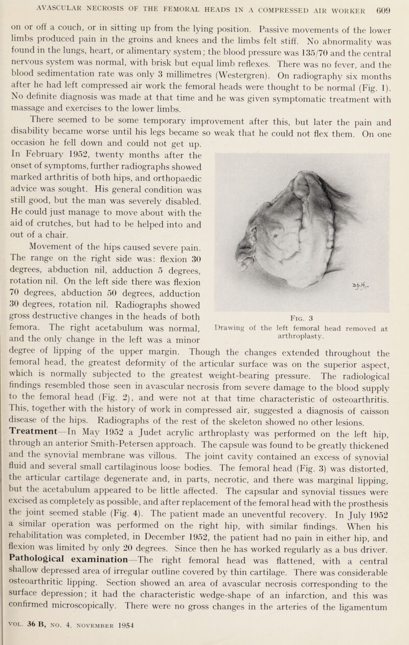 on or off a couch, or in sitting up from the lying position. Passive movements of the lower limbs produced pain m the groins and knees and the limbs felt stiff. No abnormality was found in the lungs, heart, or alimentary system ; the blood pressure was 135/70 and the central nervous system was normal, with brisk but equal limb reflexes, there was no fever, and the blood sedimentation rate was only 3 millimetres (Westergren). On radiography six months after he had left compressed air work the femoral heads were thought to be normal (Fig. 1). No definite diagnosis was made at that time and he was given symptomatic treatment with massage and exercises to the lower limbs. There seemed to be some temporary improvement after this, but later the pain and disability became worse until his legs became so weak that he could not flex them. On one occasion he fell down and could not get up. In February 1952, twenty months after the onset of symptoms, further radiographs showed marked arthritis of both hips, and orthopaedic advice was sought. His general condition was still good, but the man was severely disabled. He could just manage to move about with the aid of crutches, but had to be helped into and out of a chair. Movement of the hips caused severe pain. The range on the right side was: flexion 30 degrees, abduction nil, adduction 5 degrees, rotation nil. On the left side there was flexion 70 degrees, abduction 50 degrees, adduction 30 degrees, rotation nil. Radiographs showed gross destructive changes in the heads of both femora. The right acetabulum was normal, Drawing of the left femoral head removed at and the only change in the left was a minor arthroplasty. degree of lipping of the upper margin. Though the changes extended throughout the femoral head, the greatest deformity of the articular surface was on the superior aspect, which is normally subjected to the greatest weight-bearing pressure. The radiological findings resembled those seen in avascular necrosis from severe damage to the blood supply to the femoral head (Fig. 2), and were not at that time characteristic of osteoarthritis. This, together with the history of work in compressed air, suggested a diagnosis of caisson disease of the hips. Radiographs of the rest of the skeleton showed no other lesions. Treatment In May 1952 a Judet acrylic arthroplasty was performed on the left hip, through an anterior Smith-Petersen approach. The capsule was found to be greatly thickened and the synovial membrane was villous. The joint cavity contained an excess of synovial fluid and several small cartilaginous loose bodies. The femoral head (Fig. 3) was distorted, che articular cartilage degenerate and, in parts, necrotic, and there was marginal lipping, but the acetabulum appeared to be little affected. The capsular and synovial tissues were excised as completely as possible, and after replacement of the femoral head with the prosthesis the joint seemed stable (Fig. 4). The patient made an uneventful recovery. In July 1952 a similar operation was performed on the right hip, with similar findings. When his rehabilitation was completed, in December 1952, the patient had no pain in either hip, and flexion was limited by only 20 degrees. Since then he has worked regularly as a bus driver. Pathological examination—The right femoral head was flattened, with a central shallow depressed area of irregular outline covered by thin cartilage. There was considerable osteoarthritic lipping. Section showed an. area of avascular necrosis corresponding to the surface depression; it had the characteristic wedge-shape of an infarction, and this was confirmed microscopically. There were no gross changes in the arteries of the ligamentum Fig. 3