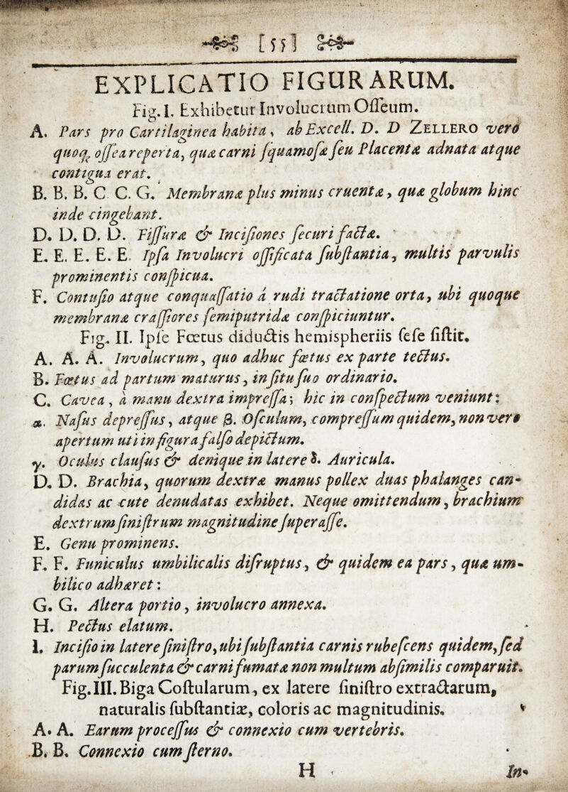 EXPLICATIO FIGURARUM. rig.l. Exhibetur Involucrum Ofleum. A. Pars pro Cartilaginea habita, abExcell.D. D Zellero vero quoq? ojjea reperta. qua carni Jquamofe feu Placenta adnata atque contigua erat. B. B. B. C. C. G. Membrana plus minus cruenta, qua globum hinc inde cingebant. D. D. D. D. Fiffura & Incifiones fecuri fati a. • E. E. E. E. E. Ipfa Involucri offificata fubfantia, multis parvulis prominentis confiicua. F. Contufio atque conquaffatio d rudi tractatione orta, ubi quoque membrana craffiores femiputrida conficiuntur. Fig. II. Ipie Fcecus diducis hemispheriis fefe fiftit. A. A. A. Involucrum, quo adhuc fastus ex parte tetius. B. Fcetus ad partum maturus, in f tu fu e ordinario. C. Cavea , d manu dextra impreffa; hic in confpetlum veniunt'. x, IIa fu s deprejfus, atque /3. ofculum, compreffum quidem,nonver0 apertum uti in figura falfo depilium. y. Oculus clau fus dr denique in latere Auricula. D. D. Brachia, quorum dextra manus pellex duas phalanges can¬ didas ac cute denudatas exhibet. Neque omittendum, brachium dextrumfniftrum magnitudineJuperaJfe. E. Genu prominens. F. F. Funiculus umbilicalis difruptus, & quidem ea pars, qua um¬ bilico adhaeret: G. G. Altera portio, involucro annexa. H. Fetius elatum. i. Incifio in latere (inifiro, ubifubflantia carnis rubefcens quidem, fed parumfuc culent a & carnifumat a non multum abfimilis comp aruit. Fig. III. Biga Coftularum, ex latere finiftro extra&arum, naturalis fubftantiae, coloris ac magnitudinis. v A» A. Earum procejfus & connexio cum vertebris. .B. B. Connexio cum jlerno, H * In*