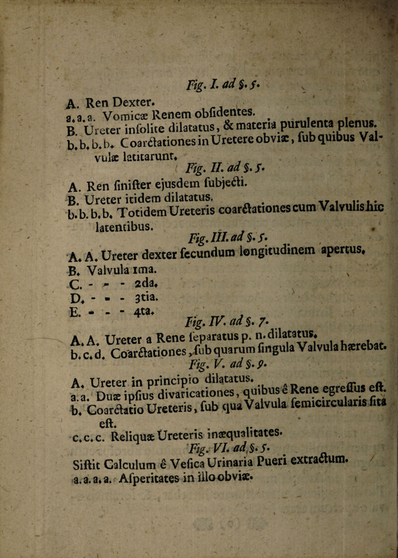 > Fig. I. ad §. /. , . A. Ren Dexter. ]• a. a a Vomicae Renem oblidentes. B Ureter infolite dilatatus, & materia purulenta plenus. b. b.b.b, C oarclationes in Uretere obviae, fub quibus Val¬ vulae latitarunt, , . ( Fig. II. ad §. f. A. Ren linifter ejusdem fubjeti. B. Ureter itidem dilatatus. b. b. b.b. Totidem Ureteris coartationes cum Valvulisinc latentibus. . , Fig. III. ad §.f. _ ' A. A. Ureter dexter fecundum longitudinem apertus, B. Valvula ima. x C. - - - 2da, ' ‘ . D. - - - 3«a- E. - - - 4ta. 7' Fig. IV. ad §. 7. A A Ureter a Rene leparatusp. n. dilatatus, b c. d Coartationes ,fub quarum fingula Valvula hserebat. ' Fig. V. ad§.9. b, CoartaL Ureteris, fub qua Valvula femicirculans fi» eft. - .. „ ' c. c.c. Reliqua Ureteris inaequalitates. Fig.- VI. ad, •§. 5. Siftit Calculum e Vefica Urinaria Pueri extractum, a. a. a. a. Afperitates in illoobvise. - [