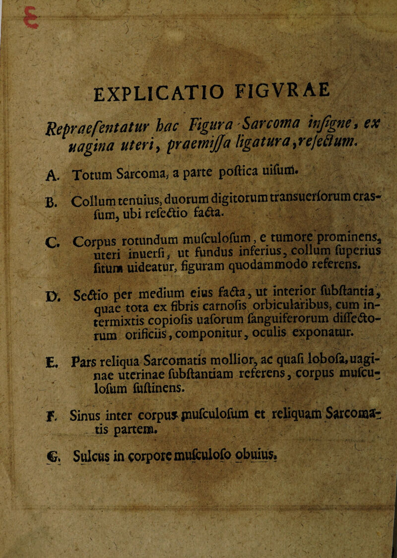 EXPLICATIO FIGVRAE Repraefentatur hac Figura - Sarcoma injigne, ex uagina uterit praernijja ligatura ^reje^lutn, A. Totum Sarcoma, a parte poftica uifum. B. Collum tenuius, duorum digitorum transuerlorum cras* fum, ubi refe&io fa£ta. v c. Corpus rotundum mufculofum, e tumore prominens, meri inuerfi, ut fundus inferius, collum fuperius fitiim uideatur, figuram quodammodo referens. I> Seftio per medium eius fa&a, ut interior fubftantia, quae tota ex fibris carnofis orbicularibus, cum in¬ termixtis copiofis uaforum fanguiferorum differto¬ rum orificiis, componitur, oculis exponatur. E. Pars reliqua Sarcomatis mollior, ac quali lobofa,uagi- nae uterinae fubftantiam referens, corpus mufcu¬ lofum fiiftinens. f, Sinus inter corpu» jnufculofum et reliquam Sarcoma¬ tis partem. €. Sulcus in corpore mufculofo obuius, * i /