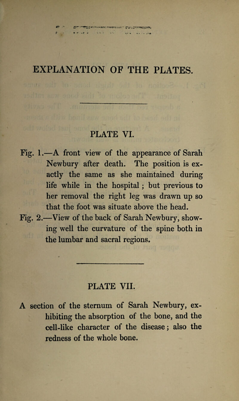 tr ~ f w.r V* * » • • ~r~-W EXPLANATION OF THE PLATES. PLATE VI. Fig. 1.—A front view of the appearance of Sarah Newbury after death. The position is ex¬ actly the same as she maintained during life while in the hospital; but previous to her removal the right leg was drawn up so that the foot was situate above the head. Fig. 2.—View of the back of Sarah Newbury, show¬ ing well the curvature of the spine both in the lumbar and sacral regions. PLATE VII. A section of the sternum of Sarah Newbury, ex¬ hibiting the absorption of the bone, and the cell-like character of the disease; also the redness of the whole bone.