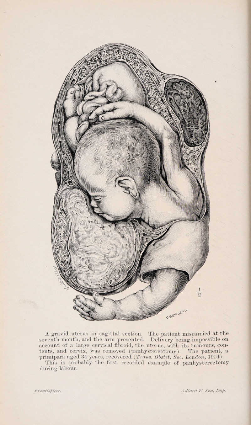 A gravid uterus in sagittal section. The patient miscarried at the seventh month, and the arm presented. Delivery being impossible on account of a large cervical fibroid, the uterus, with its tumours, con¬ tents, and cervix, was removed (panhysterectomy). The patient, a primipara aged 34 years, recovered (Trans. Obstet. Soc. London, 1904). This is probably the first recorded example of panliysterectomy during labour. Frontispiece. Ad lard & Son, Imp.