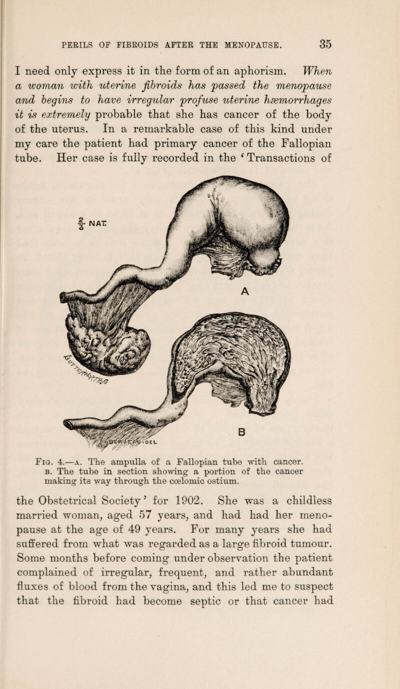 I need only express it in the form of an aphorism. When a woman with uterine fibroids has passed the menopause and begins to have irregular profuse uterine haemorrhages it is extremely probable that she has cancer of the body of the uterus. In a remarkable case of this kind under my care the patient had primary cancer of the Fallopian tube. Her case is fully recorded in the f Transactions of Fig. 4.—a. The ampulla of a Fallopian tube with cancer. b. The tube in section showing a portion of the cancer making its way through the coelomic ostium. the Obstetrical Society’ for 1902. She was a childless married woman, aged 57 years, and had had her meno¬ pause at the age of 49 years. For many years she had suffered from what was regarded as a large fibroid tumour. Some months before coming under observation the patient complained of irregular, frequent, and rather abundant fluxes of blood from the vagina, and this led me to suspect that the fibroid had become septic or that cancer had