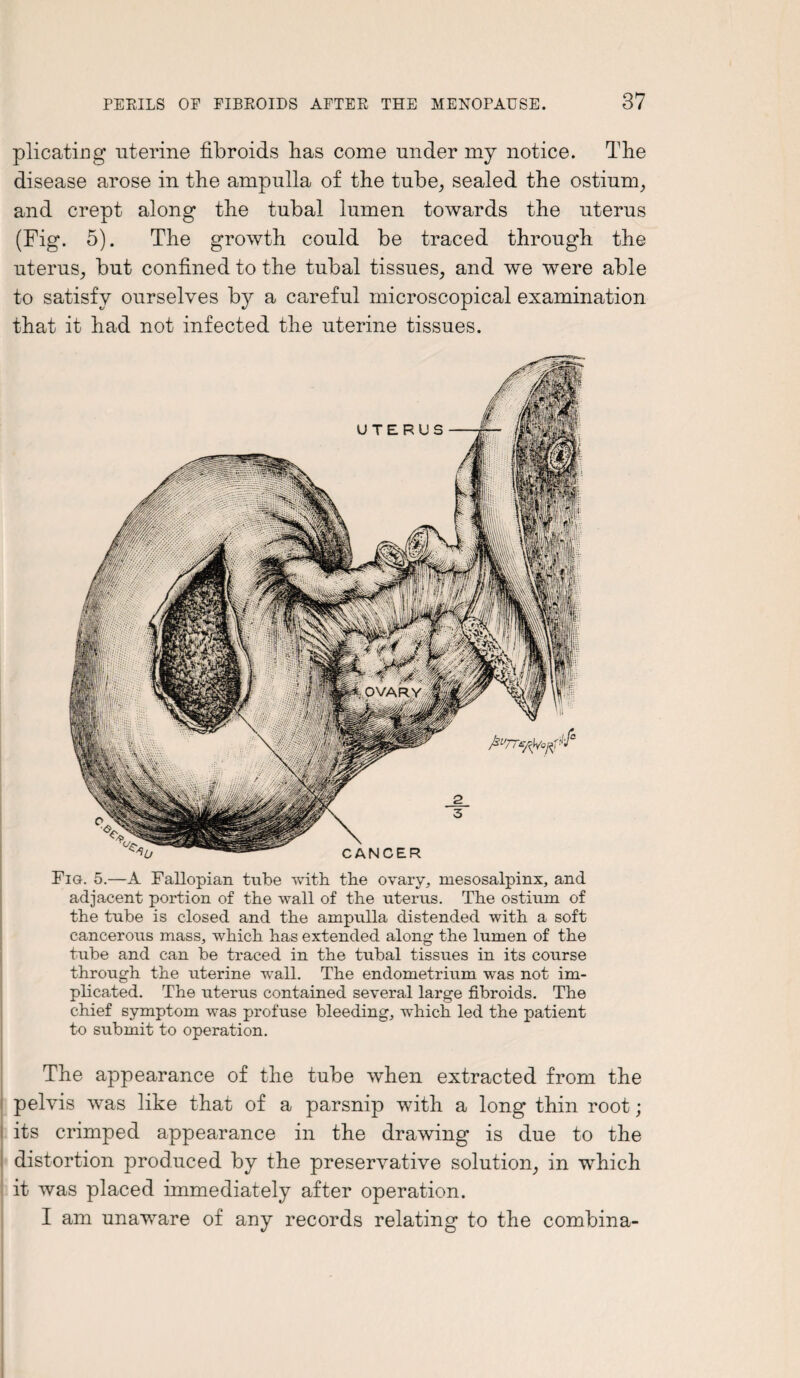 plicating uterine fibroids lias come under my notice. The disease arose in the ampulla of the tube, sealed the ostium, and crept along the tubal lumen towards the uterus (Fig. 5). The growth could be traced through the uterus, but confined to the tubal tissues, and we were able to satisfy ourselves by a careful microscopical examination that it had not infected the uterine tissues. Fig. 5.—A Fallopian tube with the ovary, mesosalpinx, and adjacent portion of the wall of the uterus. The ostium of the tube is closed and the ampulla distended with a soft cancerous mass, which has extended along the lumen of the tube and can be traced in the tubal tissues in its course through the uterine wall. The endometrium was not im¬ plicated. The uterus contained several large fibroids. The chief symptom was profuse bleeding, which led the patient to submit to operation. The appearance of the tube when extracted from the pelvis was like that of a parsnip with a long thin root; its crimped appearance in the drawing is due to the distortion produced by the preservative solution, in which it was placed immediately after operation. I am unaware of any records relating to the combina-