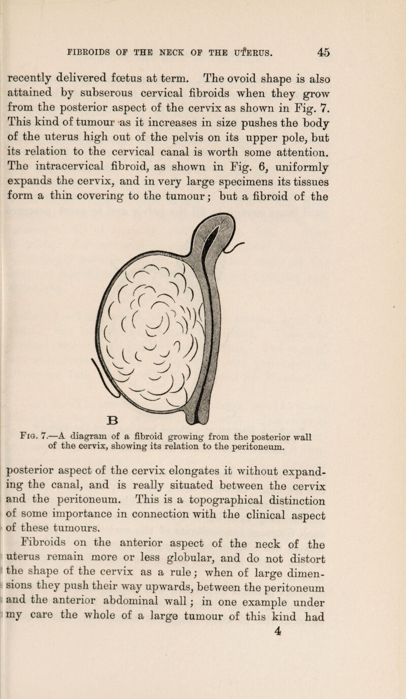 recently delivered foetus at term. The ovoid shape is also attained by subserous cervical fibroids when they grow from the posterior aspect of the cervix as shown in Fig. 7. This kind of tumour as it increases in size pushes the body of the uterus high out of the pelvis on its upper pole, but its relation to the cervical canal is worth some attention. The intracervical fibroid, as shown in Fig. 6, uniformly expands the cervix, and in very large specimens its tissues form a thin covering to the tumour; but a fibroid of the Fig. 7.—A diagram of a fibroid growing from the posterior wall of the cervix^ showing its relation to the peritoneum. posterior aspect of the cervix elongates it without expand¬ ing the canal, and is really situated between the cervix and the peritoneum. This is a topographical distinction of some importance in connection with the clinical aspect of these tumours. Fibroids on the anterior aspect of the neck of the uterus remain more or less globular, and do not distort the shape of the cervix as a rule; when of large dimen¬ sions they push their way upwards, between the peritoneum and the anterior abdominal wall; in one example under my care the whole of a large tumour of this kind had 4