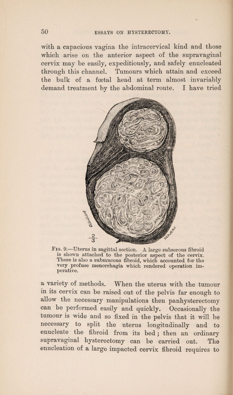 with, a capacious vagina the intracervical kind and those which arise on the anterior aspect of the supravaginal cervix may be easily, expeditiously, and safely enucleated through this channel. Tumours which attain and exceed the bulk of a foetal head at term almost invariably demand treatment by the abdominal route. I have tried Fig. 9.—Uterus in sagittal section. A large subserous fibroid is shown attached to the posterior aspect of the cervix. There is also a submucous fibroid, which accounted for the very profuse menorrhagia which rendered operation im¬ perative. a variety of methods. When the uterus with the tumour in its cervix can be raised out of the pelvis far enough to allow the necessary manipulations then panhysterectomy can be performed easily and quickly. Occasionally the tumour is wide and so fixed in the pelvis that it will be necessary to split the uterus longitudinally and to enucleate the fibroid from its bed; then an ordinary supravaginal hysterectomy can be carried out. The enucleation of a large impacted cervix fibroid requires to