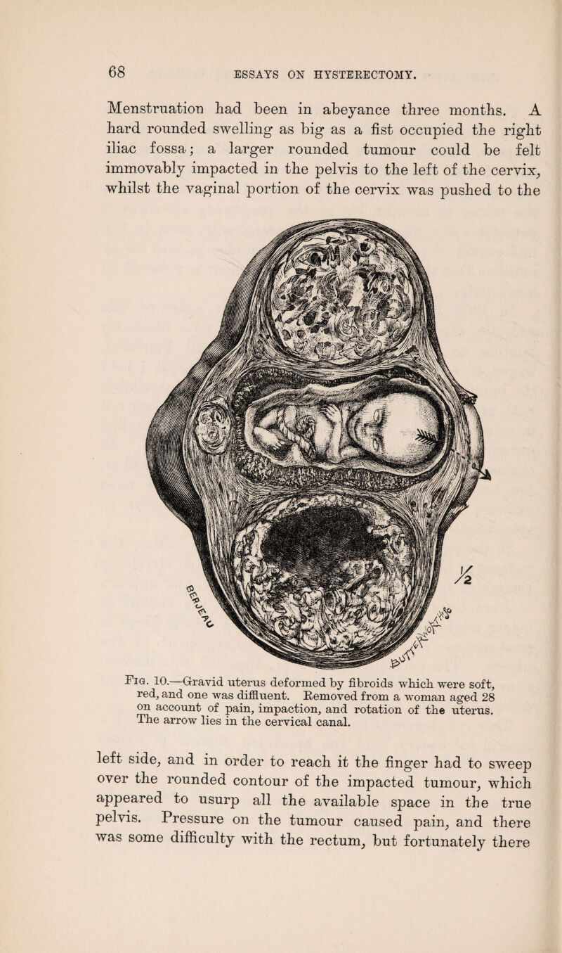 Menstruation had been in abeyance three months. A hard rounded swelling as big as a fist occupied the right iliac fossa; a larger rounded tumour could be felt immovably impacted in the pelvis to the left of the cervix, whilst the vaginal portion of the cervix was pushed to the Fig. 10.—Gravid uterus deformed by fibroids which were soft, red; and one was diffluent. Removed from a woman aged 28 on account of pain, impaction, and rotation of the uterus. The arrow lies in the cervical canal. left side, and in order to reach it the finger had to sweep over the rounded contour of the impacted tumour, which appeared to usurp all the available space in the true pelvis. Pressure on the tumour caused pain, and there was some difficulty with the rectum, but fortunately there