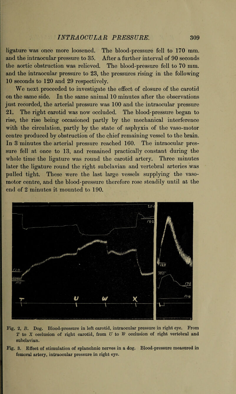 ligature was once more loosened. The blood-pressure fell to 170 mm. and the intraocular pressure to 35. After a further interval of 90 seconds the aortic obstruction was relieved. The blood-pressure fell to 70 mm. and the intraocular pressure to 23, the pressures rising in the following 10 seconds to 120 and 29 respectively. We next proceeded to investigate the effect of closure of the carotid on the same side. In the same animal 10 minutes after the observations just recorded, the arterial pressure was 100 and the intraocular pressure 21. The right carotid was now occluded. The blood-pressure began to rise, the rise being occasioned partly by the mechanical interference with the circulation, partly by the state of asphyxia of the vaso-motor centre produced by obstruction of the chief remaining vessel to the brain. In 3 minutes the arterial pressure reached 160. The intraocular pres¬ sure fell at once to 13, and remained practically constant during the whole time the ligature was round the carotid artery. Three minutes later the ligature round the right subclavian and vertebral arteries was pulled tight. These were the last large vessels supplying the vaso¬ motor centre, and the blood-pressure therefore rose steadily until at the end of 2 minutes it mounted to 190. Fig. 2, B. Dog. Blood-pressure in left carotid, intraocular pressure in right eye. From T to X occlusion of right carotid, from U to W occlusion of right vertebral and subclavian. Fig. 3. Effect of stimulation of splanchnic nerves in a dog. Blood-pressure measured in femoral artery, intraocular pressure in right eye.