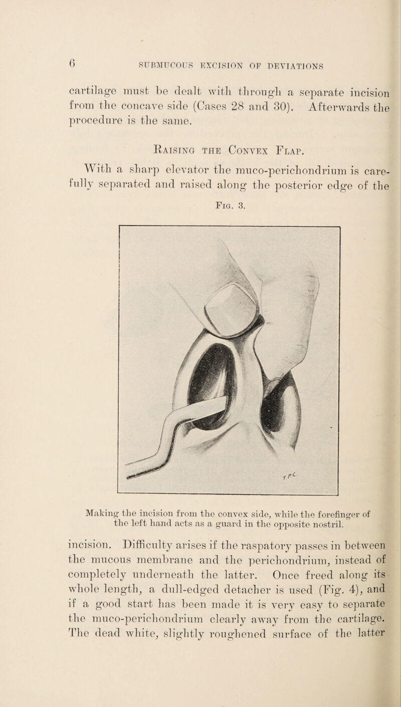 cartilage must be dealt with through a separate incision from the concave side (Cases 28 and 30). Afterwards the procedure is the same. Raising the Convex Flap. With a sharp elevator the muco-perichondrium is care¬ fully separated and raised along the posterior edge of the Fig. 3. Making the incision from the convex side, while the forefinger of the left hand acts as a guard in the opposite nostril. incision. Difficulty arises if the raspatory passes in between the mucous membrane and the perichondrium, instead of completely underneath the latter. Once freed along its whole length, a dull-edged detacher is used (Fig. 4), and if a good start has been made it is very easy to separate the muco-perichondrium clearly away from the cartilage. The dead white, slightly roughened surface of the latter