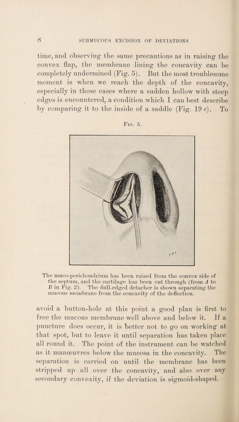 time^ and observing the same precautions as in raising the convex flap,, the membrane lining the concavity can be completely undermined (Fig. 5). But the most troublesome moment is when we reach the depth of the concavity; especially in those cases where a sudden hollow with steep edges is encountered; a condition which I can best describe by comparing it to the inside of a saddle (Fig. 19 c). To Fig. 5. The muco-perichondrium lias been raised from the convex side of the septum, and the cartilage has been cut through (from A to B in Fig. 2). The dull-edged detacher is shown separating the mucous membrane from the concavity of the deflection. avoid a button-hole at this point a good plan is first to free the mucous membrane well above and below it. If a puncture does occur; it is better not to go on working at that spot; but to leave it until separation has taken place all round it. The point of the instrument can be watched as it manoeuvres below the mucosa in the concavity. The separation is carried on until the membrane has been stripped up all over the concavity; and also over any secondary convexity; if the deviation is sigmoid-shaped.