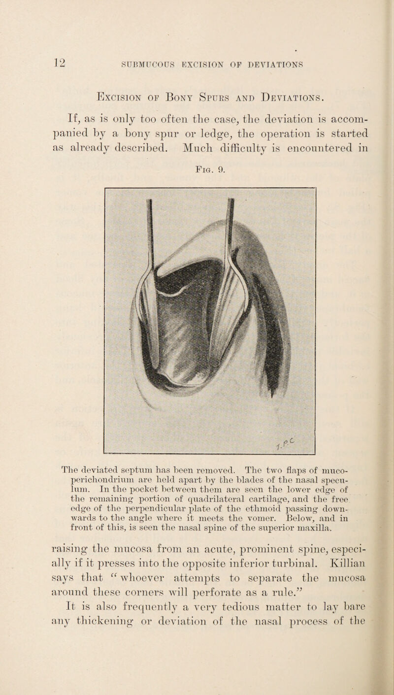 Excision of Bony Spurs and Deviations. If, as is only too often the case, the deviation is accom¬ panied by a bony spur or ledge, the operation is started as already described. Much difficulty is encountered in Fig. 9. The deviated septum has been removed. The two flaps of muco- perichondrium are held apart by the blades of the nasal specu¬ lum. In the pocket between them are seen the lower edge of the remaining portion of quadrilateral cartilage, and the free edge of the perpendicular plate of the ethmoid passing down¬ wards to the angle where it meets the vomer. Below, and in front of this, is seen the nasal spine of the superior maxilla. raising the mucosa from an acute, prominent spine, especi¬ ally if it presses into the opposite inferior turbinal. Killian says that “ whoever attempts to separate the mucosa around these corners will perforate as a rule.” It is also frequently a very tedious matter to lay bare any thickening or deviation of the nasal process of the