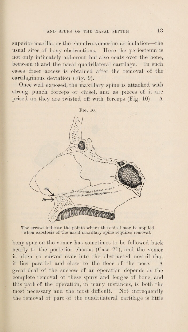 l o superior maxilla, or the chondro-vomerine articulation—the usual sites of bony obstructions. Here the periosteum is not only intimately adherent, but also coats over the bone, between it and the nasal quadrilateral cartilage. In such cases freer access is obtained after the removal of the cartilaginous deviation (Fig. 9). Once well exposed, the maxillary spine is attacked with strong punch forceps or chisel, and as pieces of it are prised up they are twisted off with forceps (Fig. 10). A Fig. 10. The arrows indicate the points where the chisel may lie applied when exostosis of the nasal maxillary spine requires removal. bony spur on the vomer has sometimes to be followed back nearly to the posterior choana (Case 21), and the vomer is often so curved over into the obstructed nostril that it lies parallel and close to the floor of the nose. A great deal of the success of an operation depends on the complete removal of these spurs and ledges of bone, and this part of the operation, in many instances, is both the most necessary and the most difficult. Not infrequently the removal of part of the quadrilateral cartilage is little