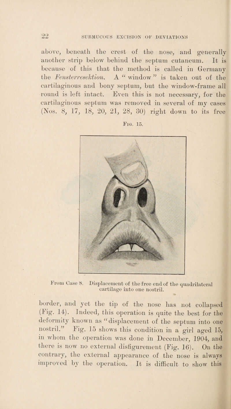 above, beneath the crest of the nose, and generally another strip below behind the septum cutaneum. It is because of this that the method is called in Germany the Fensterresektion. A “ window ” is taken out of the cartilaginous and bony septum, but the window-frame all round is left intact. Even this is not necessary, for the cartilaginous septum was removed in several of my cases (Nos. 8, 17, 18, 20, 21, 28, 30) right down to its free Fig-. 15. A From Case 8. Displacement of the free end of the quadrilateral cartilage into one nostril. border, and yet the tip of the nose has not collapsed (lig. 14). Indeed, this operation is quite the best for the deformity known as “displacement of the septum into one nostril.” Fig. 15 shows this condition in a girl aged 15, in whom the operation was done in December, 1904, and there is now no external disfigurement (Fig. 16). On the contrary, the external appearance of the nose is always improved by the operation. It is difficult to show this