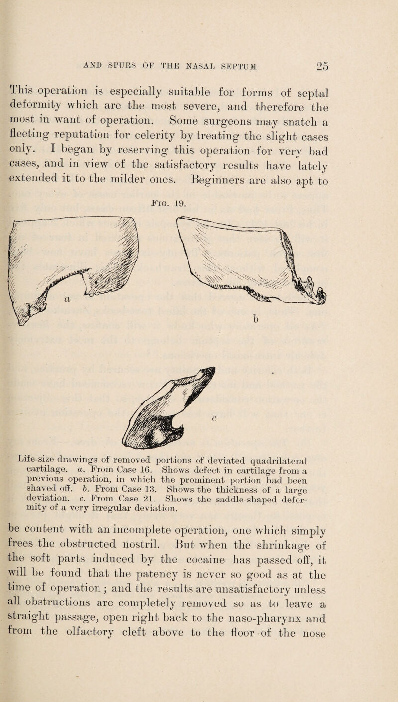 Uiis operation is especially suitable for forms of septal deformity which are the most severe, and therefore the most in want of operation. Some surgeons may snatch a fleeting reputation for celerity by treating the slight cases only. I began by reserving this operation for very bad cases, and in view of the satisfactory results have lately extended it to the milder ones. Beginners are also apt to Fig. 19. Life-size drawings of removed portions of deviated quadrilateral cartilage, a. From Case 16. Shows defect in cartilage from a previous operation, in which the prominent portion had been shaved off. b. From Case 13. Shows the thickness of a large deviation, c. From Case 21. Shows the saddle-shaped defor¬ mity of a very irregular deviation. be content with an incomplete operation, one which simply frees the obstructed nostril. But when the shrinkage of the soft parts induced by the cocaine has passed off, it will be found that the patency is never so good as at the time of operation ; and the results are unsatisfactory unless all obstructions are completely removed so as to leave a straight passage, open right back to the naso-pharynx and from the olfactory cleft above to the floor of the nose