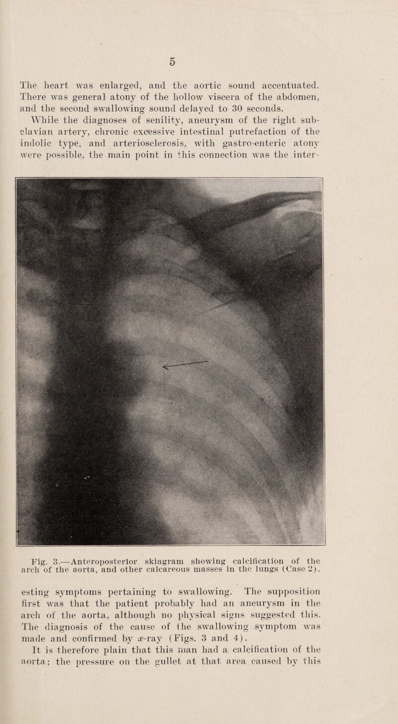 The heart was enlarged, and the aortic sound accentuated. There was general atony of the hollow viscera of the abdomen, and the second swallowing sound delayed to 30 seconds. While the diagnoses of senility, aneurysm of the right sub¬ clavian artery, chronic excessive intestinal putrefaction of the indolic type, and arteriosclerosis, with gastro-enteric atony were possible, the main point in this connection was the inter- Fig. 3.—Anteroposterior skiagram showing calcification of the arch of the aorta, and other calcareous masses in the lungs (Case 2). esting symptoms pertaining to swallowing. The supposition first was that the patient probably had an aneurysm in the arch of . the aorta, although no physical signs suggested this. The diagnosis of the cause of the swallowing symptom was made and confirmed by a?-ray (Figs. 3 and 4). It is therefore plain that this man had a calcification of the aorta; the pressure on the gullet at that area caused by this